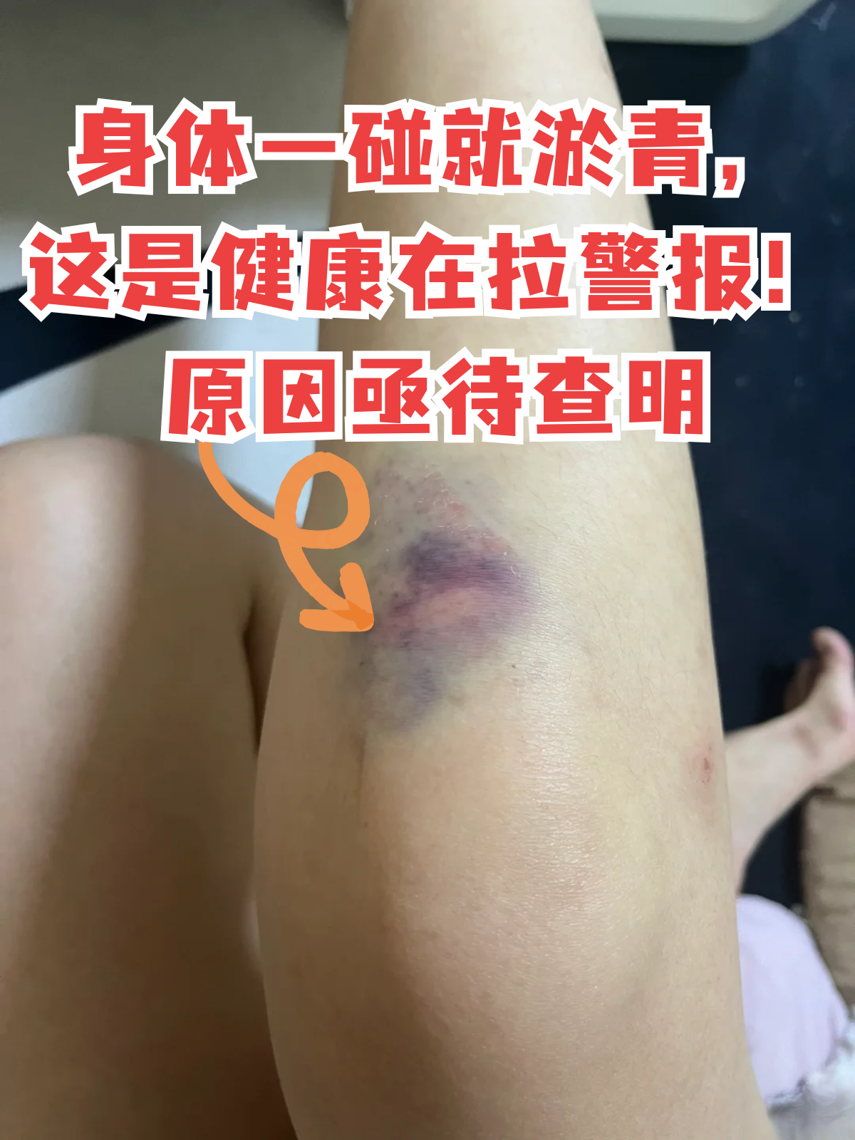 身体一碰就淤青,这是健康在拉警报!