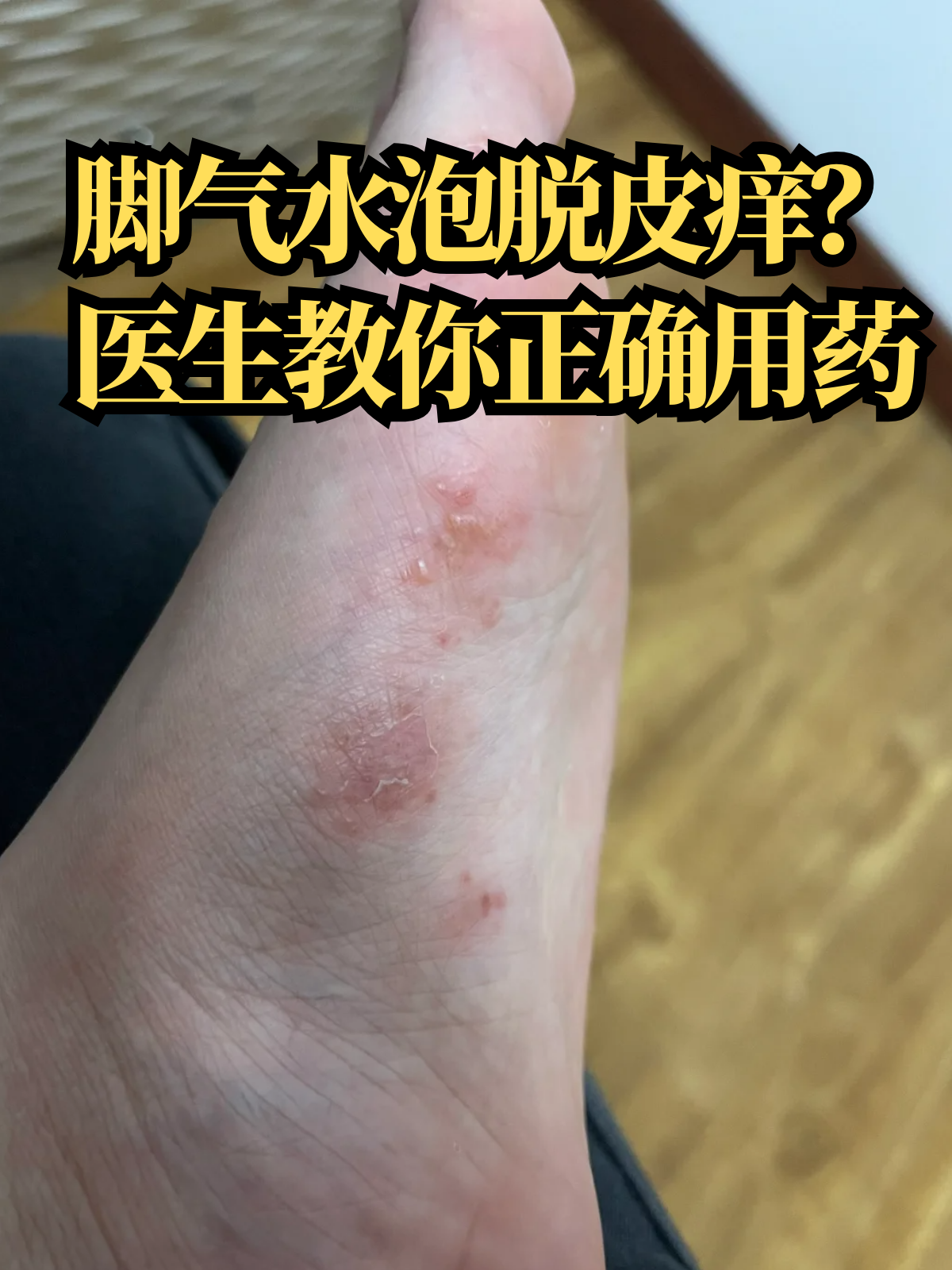 医生教你正确用药 脚气,医学上称为足癣,是由真菌感染引起的一种皮肤