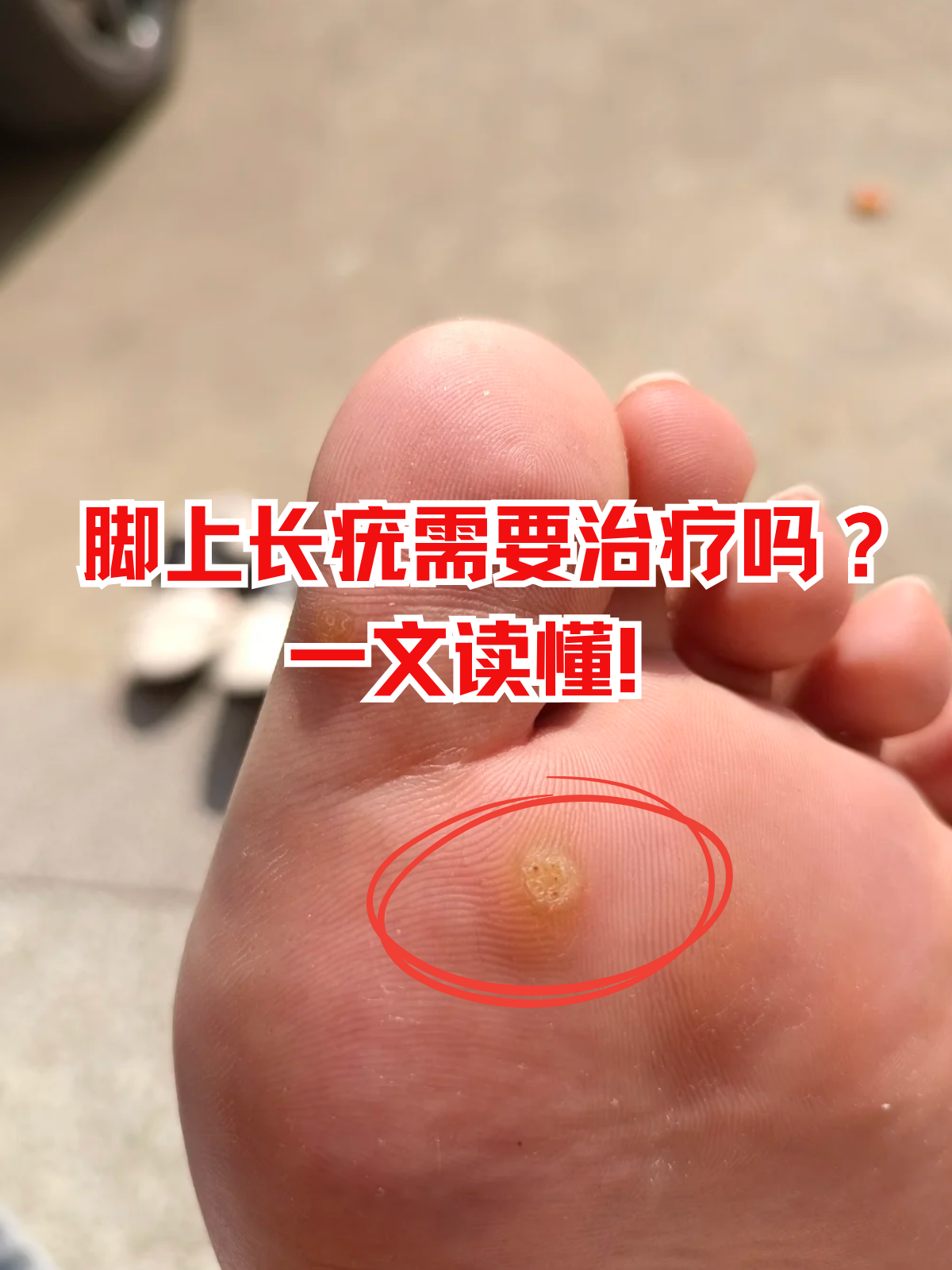 脚底或脚趾间突然冒出粗糙小疙瘩,不疼不痒却越长越多,不少人对着