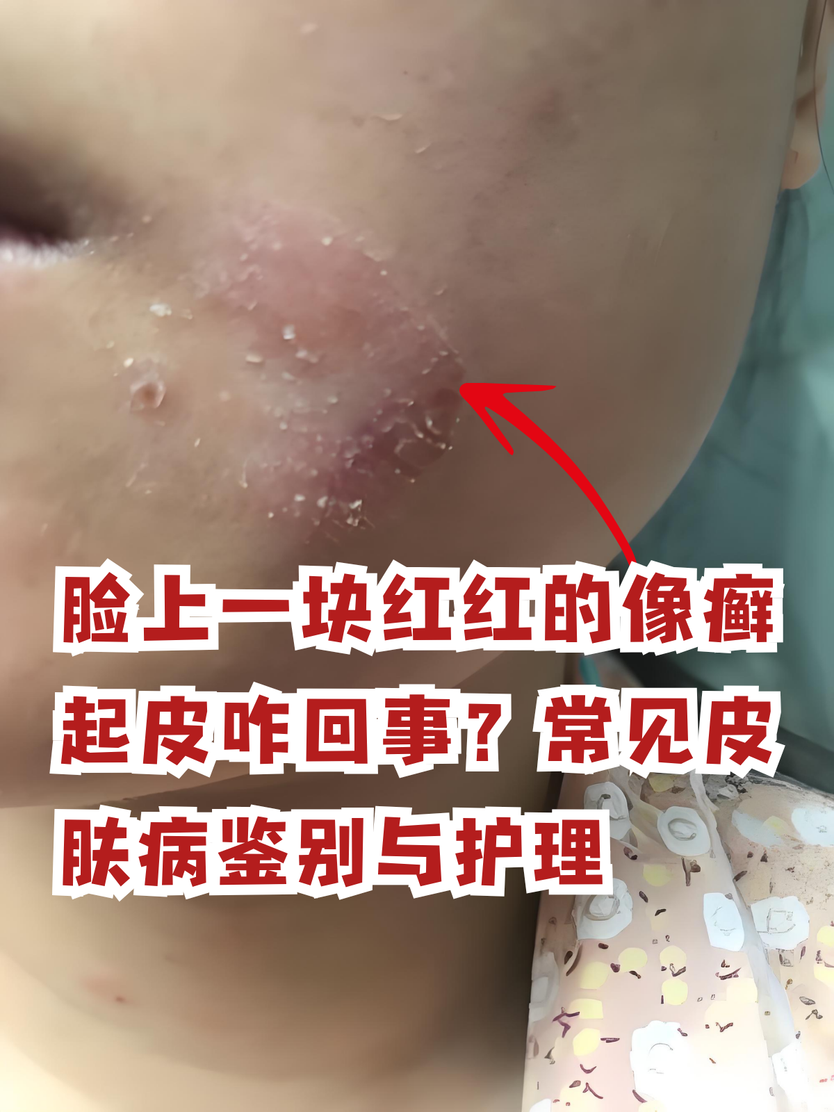 脸上一块红红的像癣起皮咋回事?