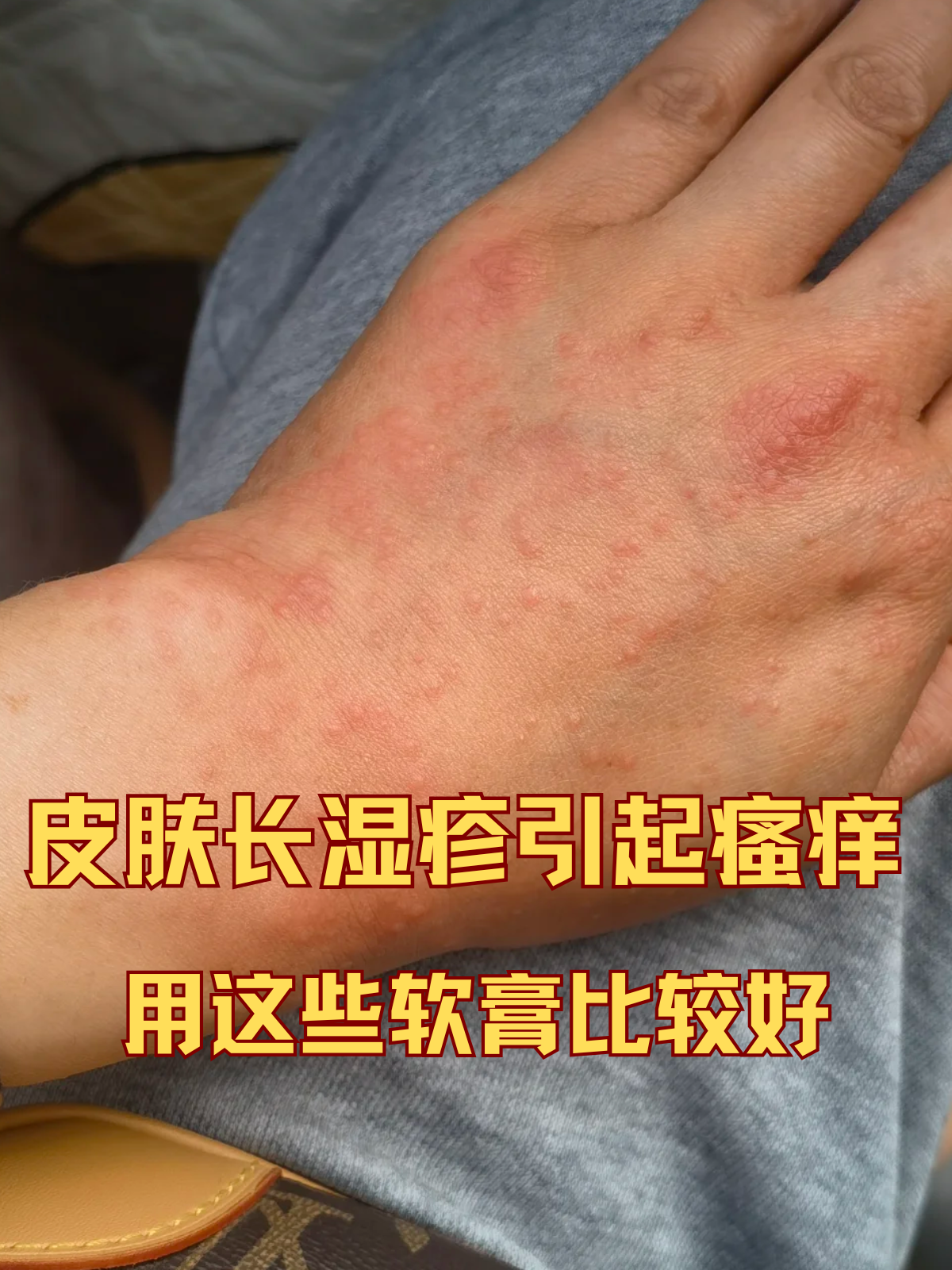 皮肤长湿疹引起瘙痒用这些软膏比较好 皮肤痒到夜不能寐,挠到皮肤破皮