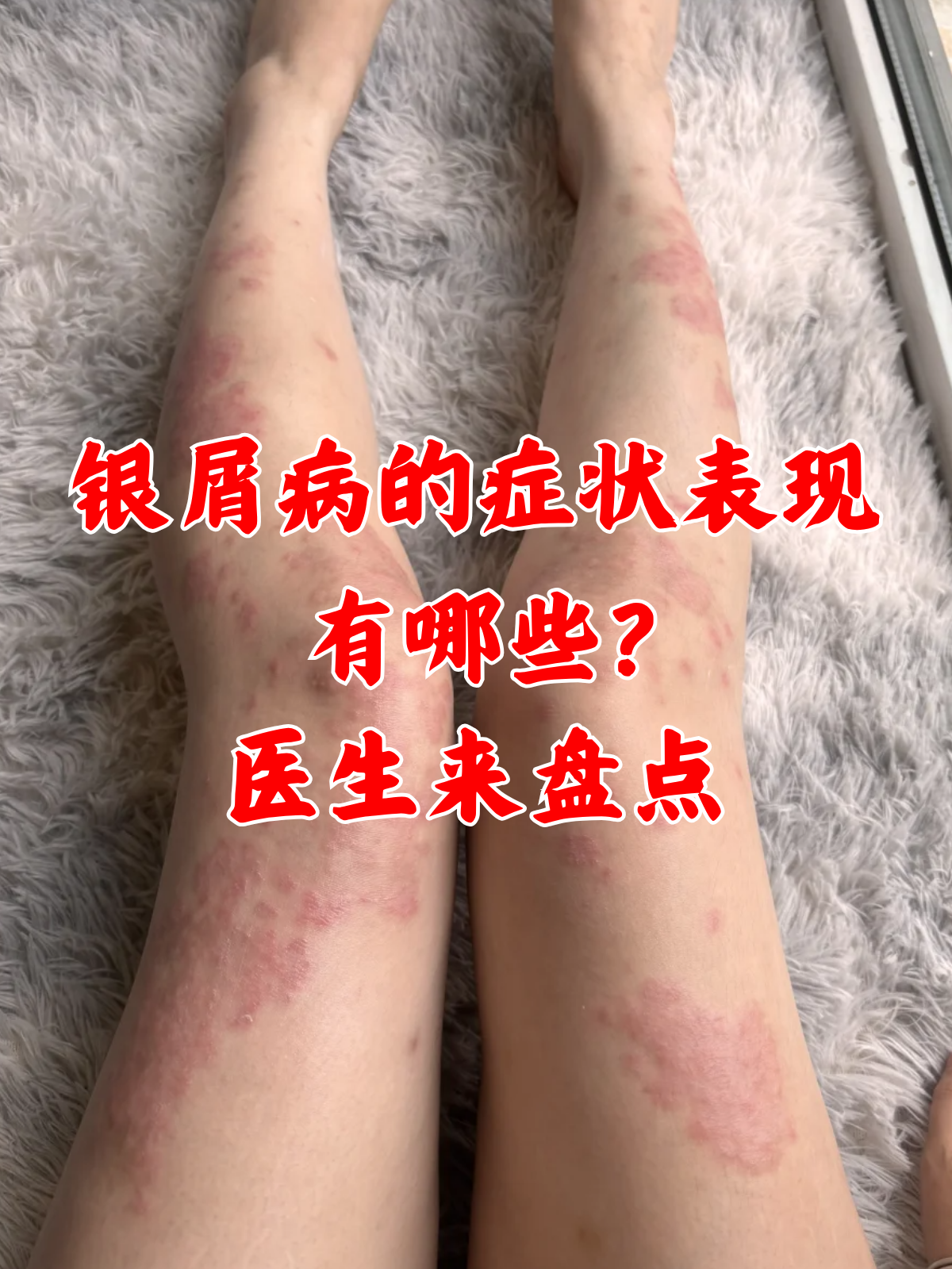 银屑病的症状表现有哪些?