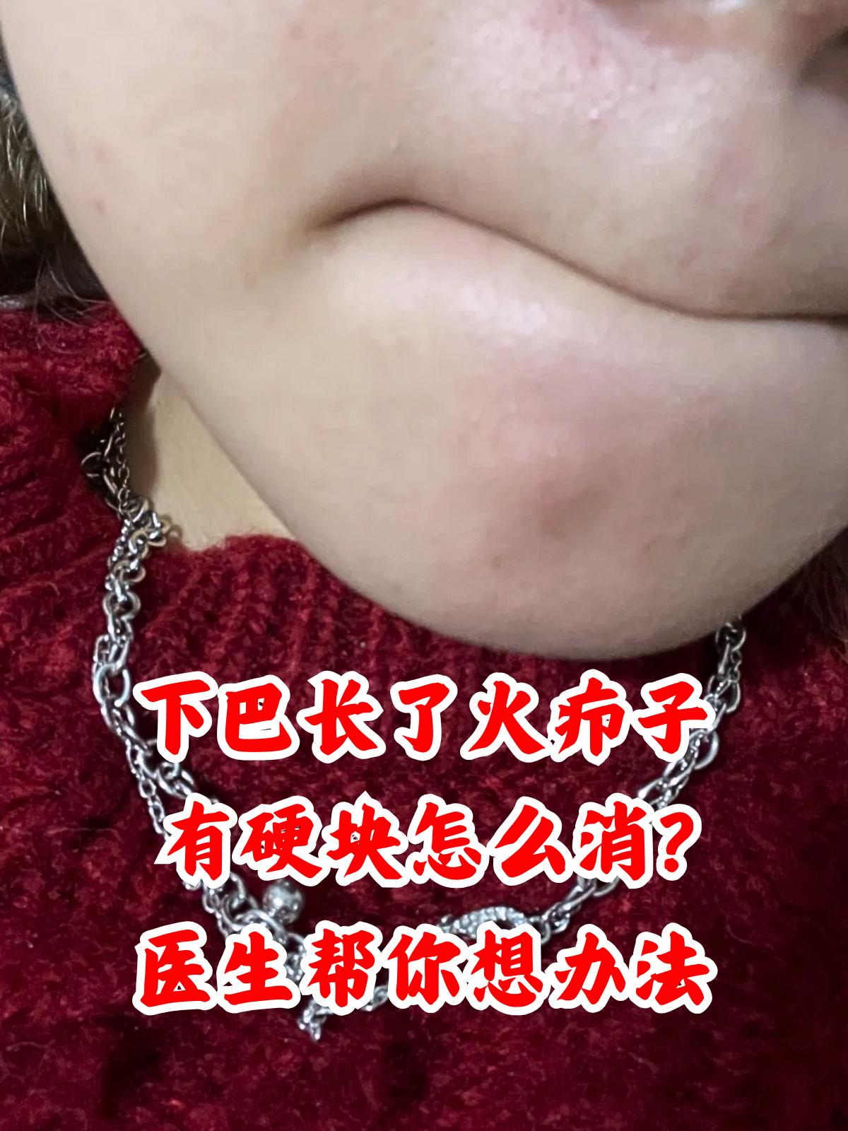 葡萄球菌引发,可能导致下巴突然冒出红肿硬块,按压时有明显的疼痛症状