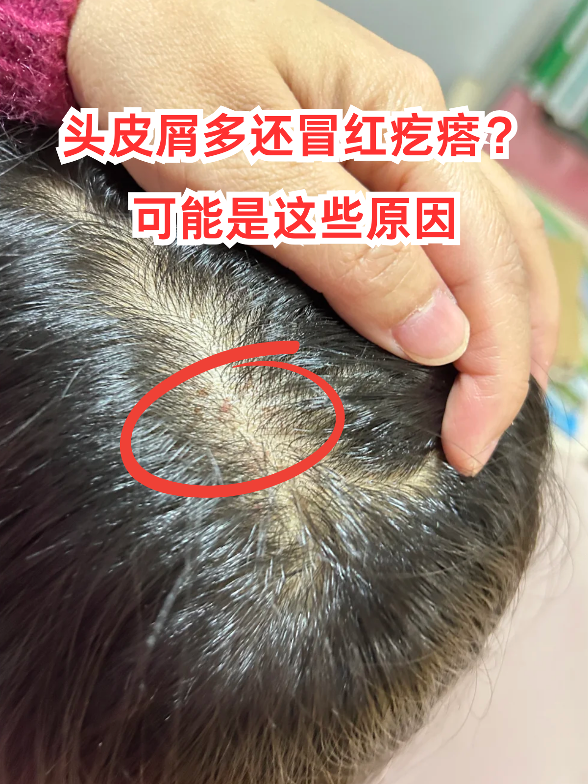 脂溢性皮炎:头皮的皮脂腺分泌旺盛