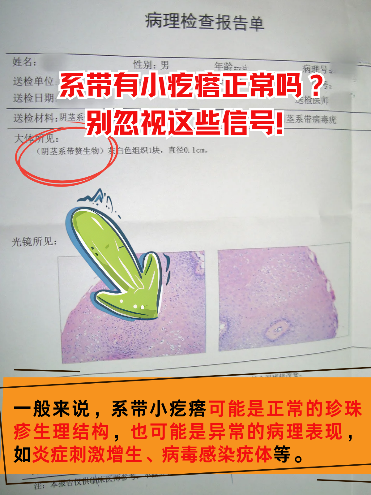 不少人发现自己系带部位出现小疙瘩,担心是严重疾病,既焦虑又不敢