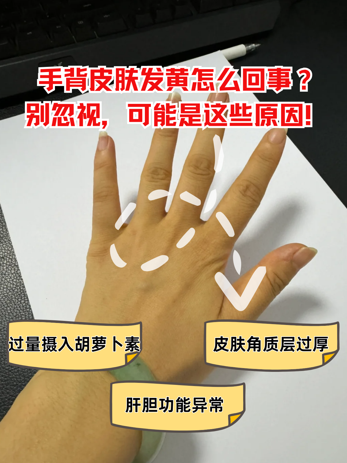 手背皮肤发黄怎么回事?别忽视,可能是这些原因!