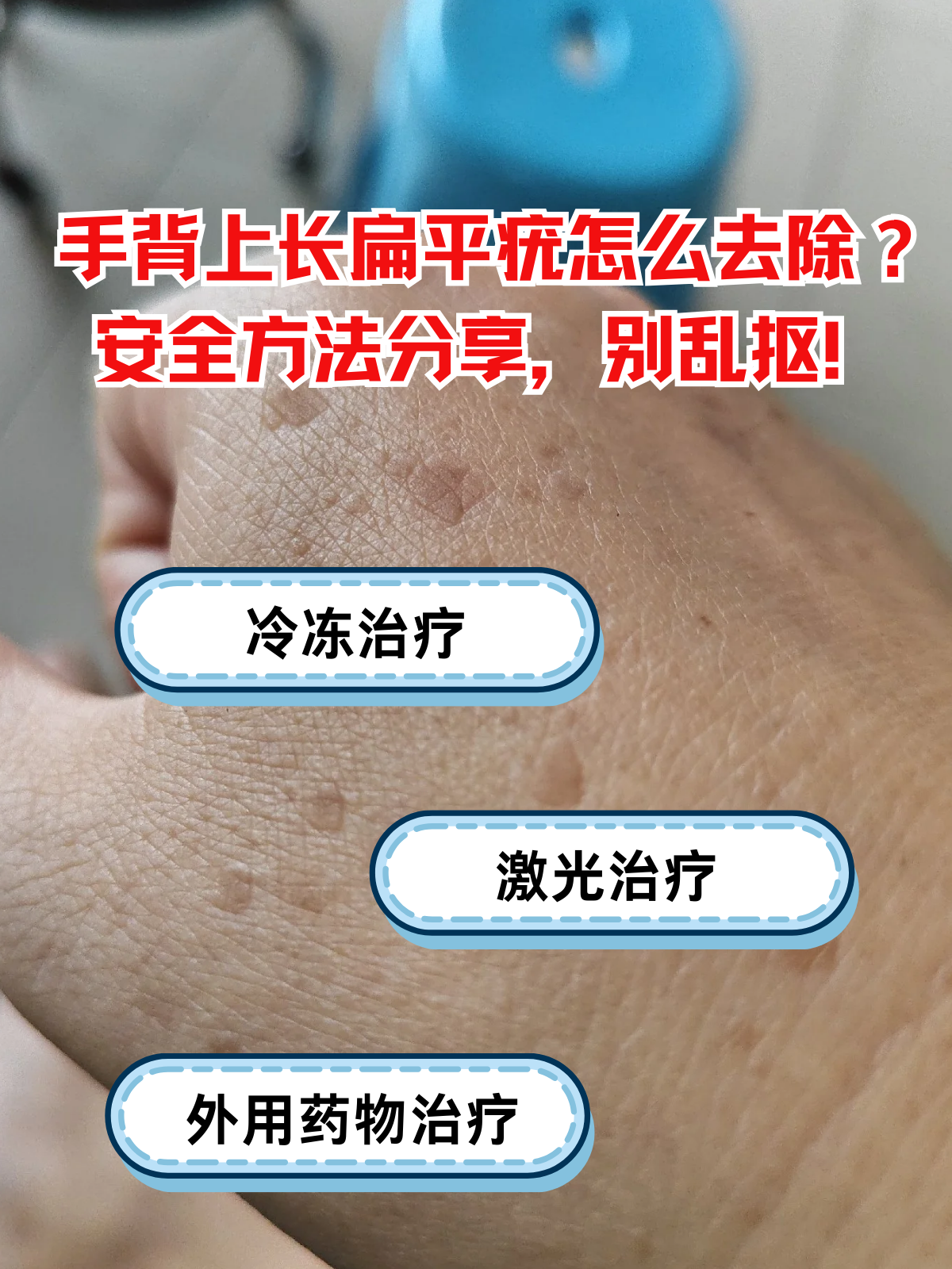 手背上长扁平疣后,不少人觉得影响美观,要么忍不住用手抠挠,要么轻信