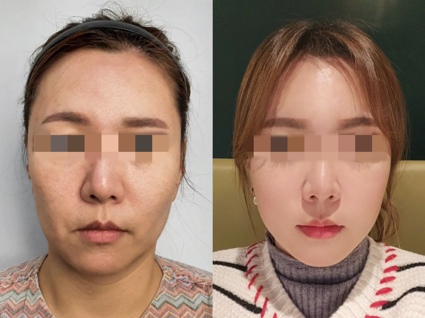 "苹果肌复位",是我见过最完美的一个项目!
