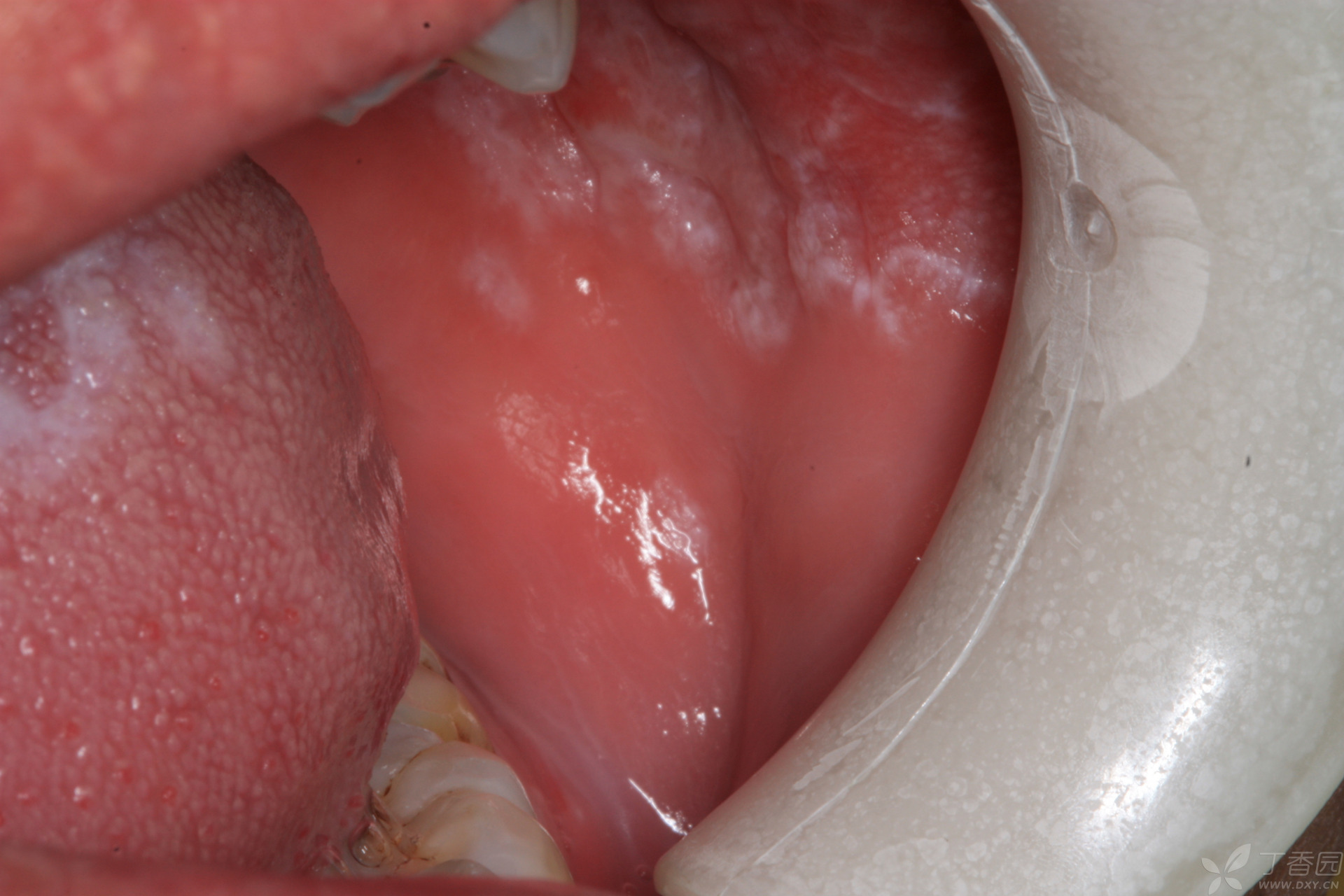 口腔扁平苔藓:小病不治,大病难医 #口腔健康是我们日常生活中不可忽视