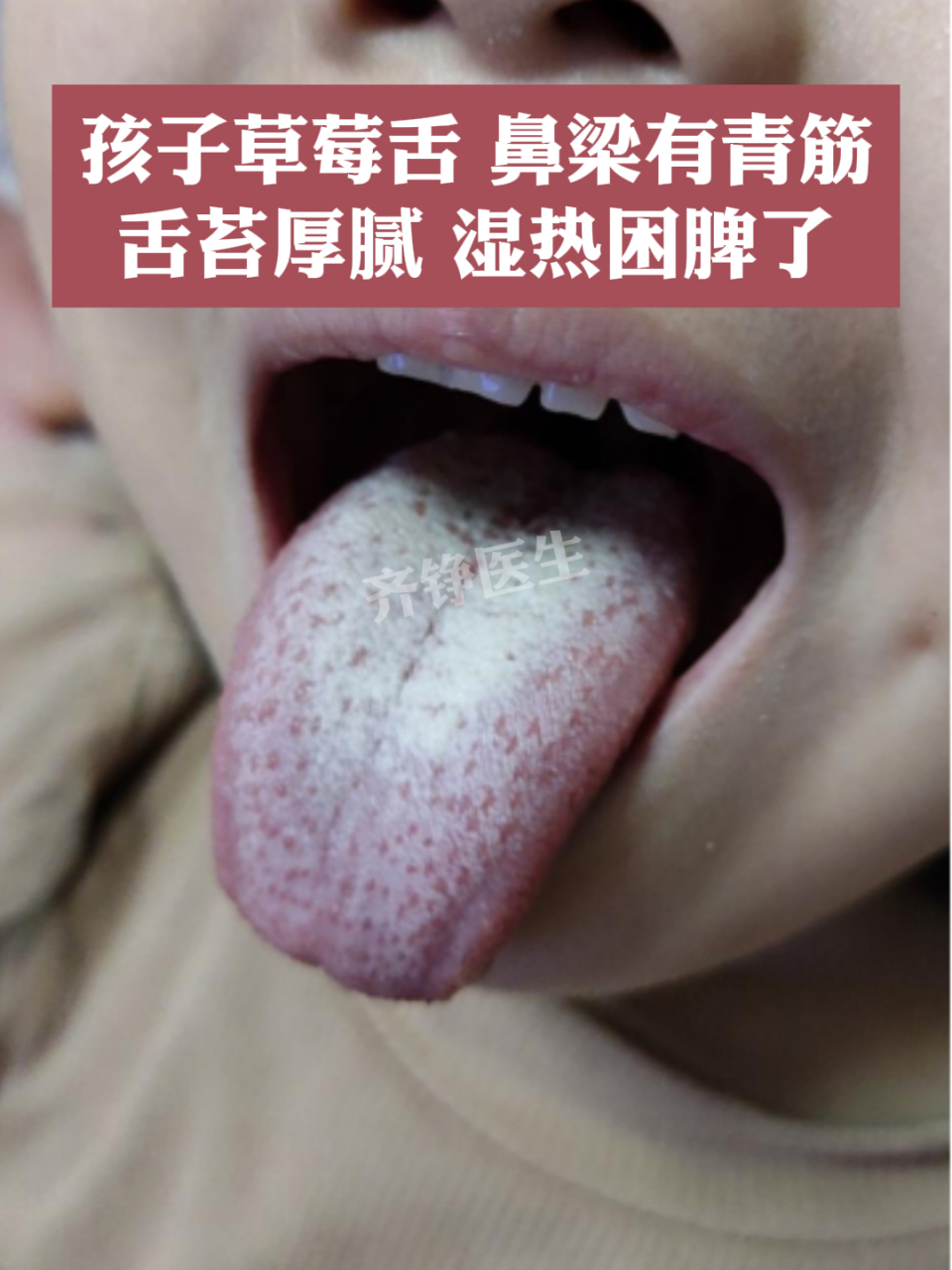 小孩子草莓舌图片