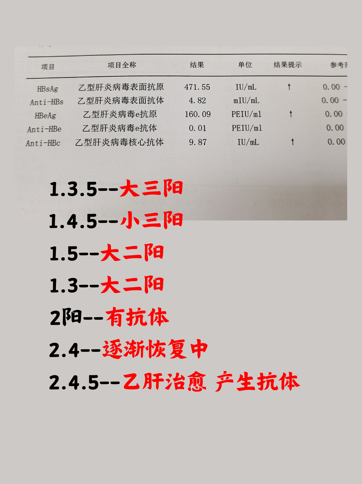 1,乙肝五项第1项阳性,其余四项阴性,说明是急性病毒感染的潜伏期