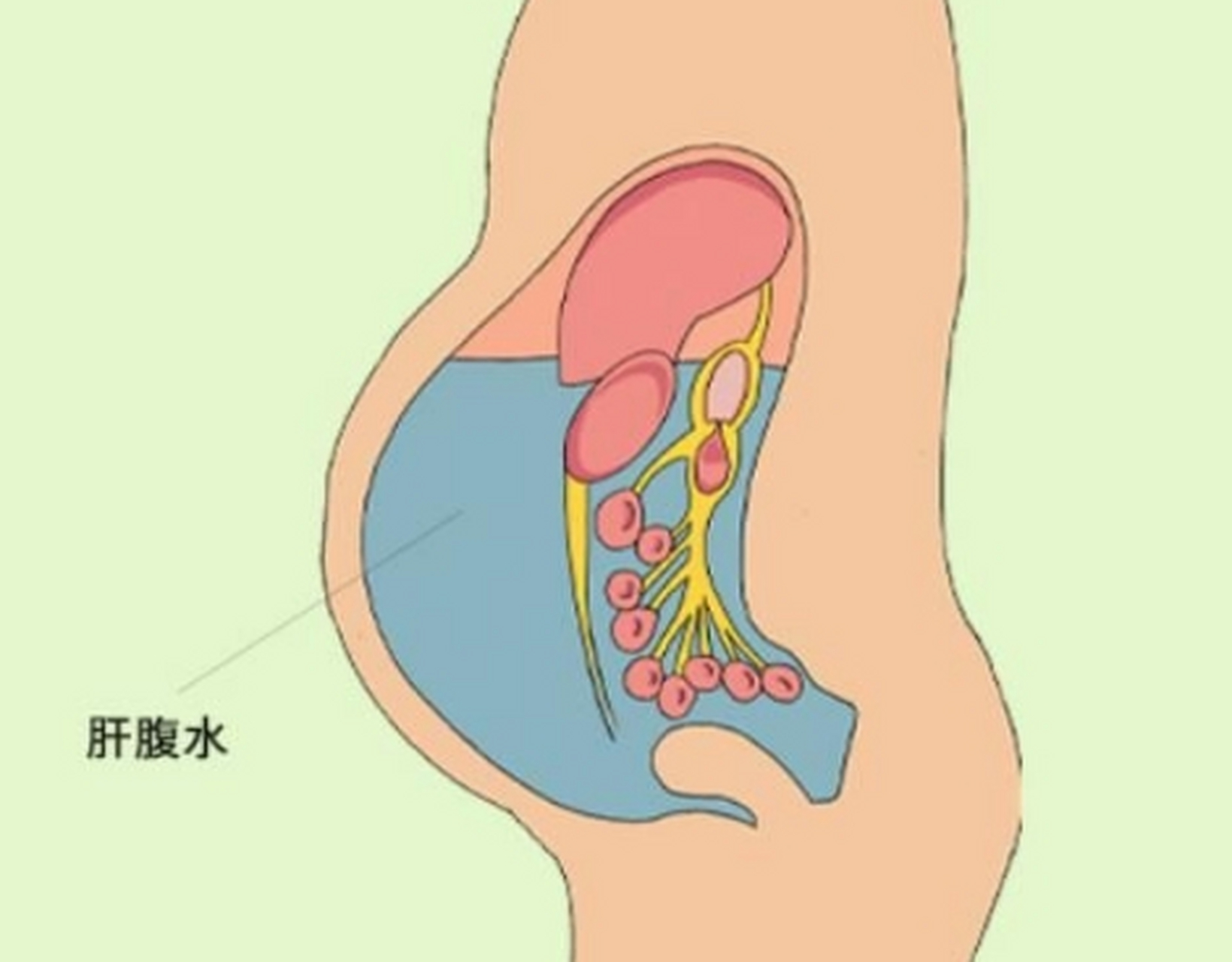 山东肝腹水男子肚子大如蛙腹,经系统治疗后未再反复.