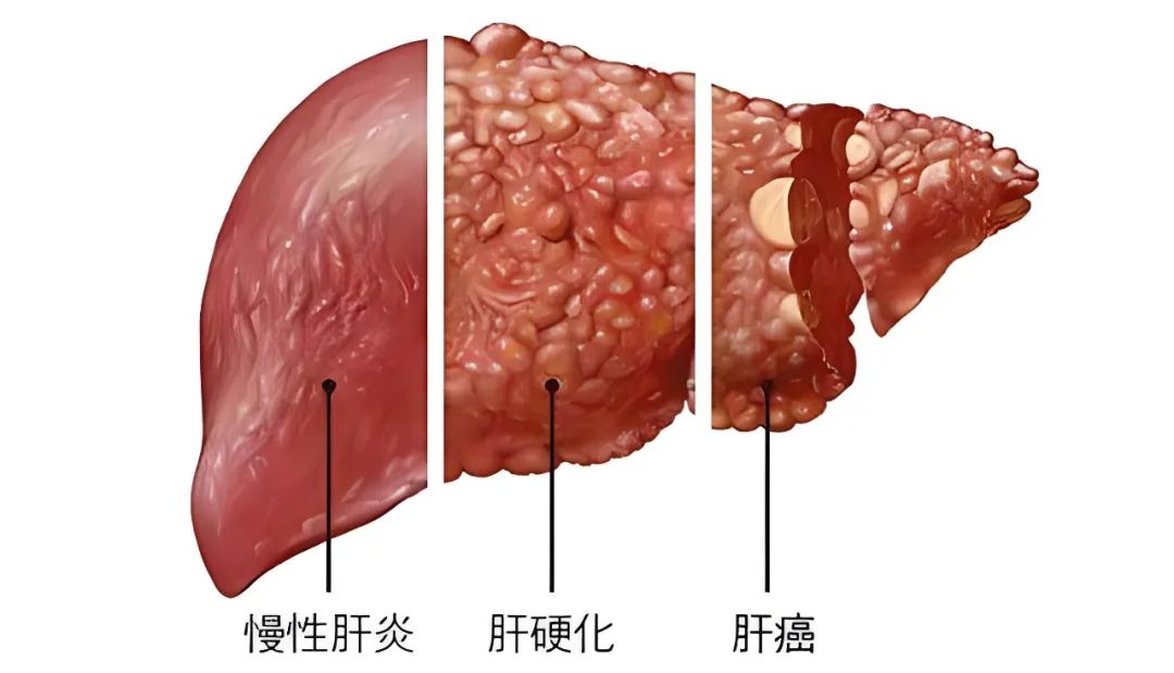 肝病朋友注意了