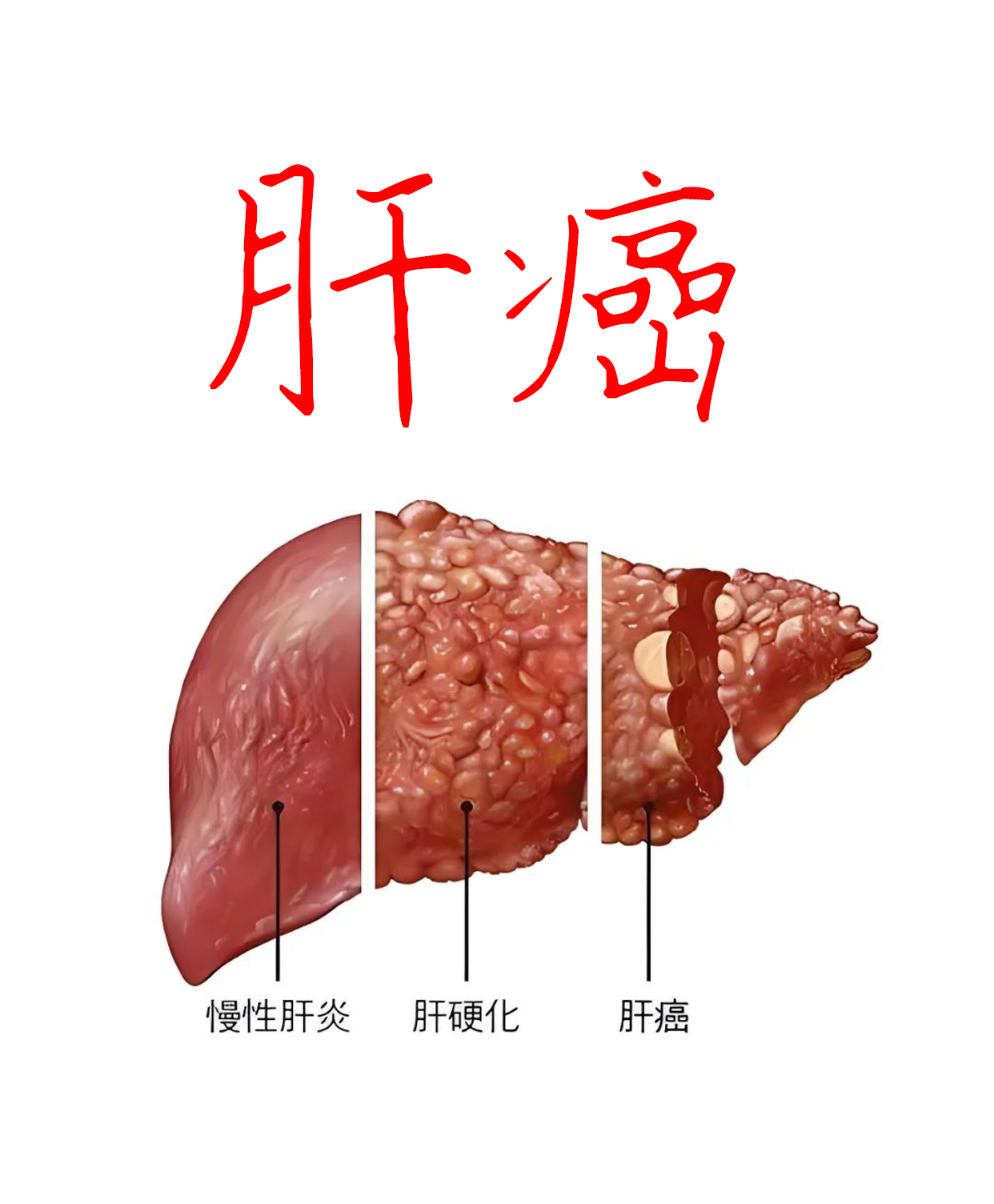 今天去查房,一位早期肝癌的患者朋友很担心自己活不长,问我还能活