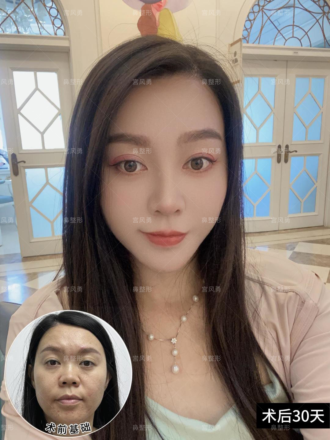 之前短鼻鼻翼肥宽鼻头圆钝~ 【半肋鼻综合】术后1个月视觉上短鼻