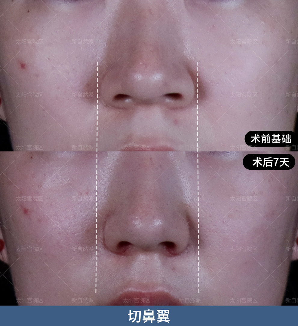 术后7天内外联合缩鼻翼的效果肉眼看得见!