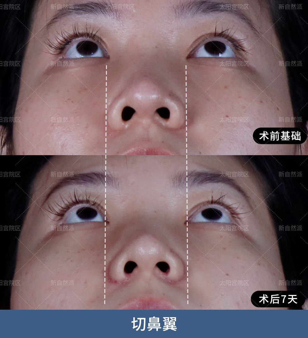 术后7天,鼻翼缩窄看似一点,但鼻头精致不止一点点~ #宫风勇