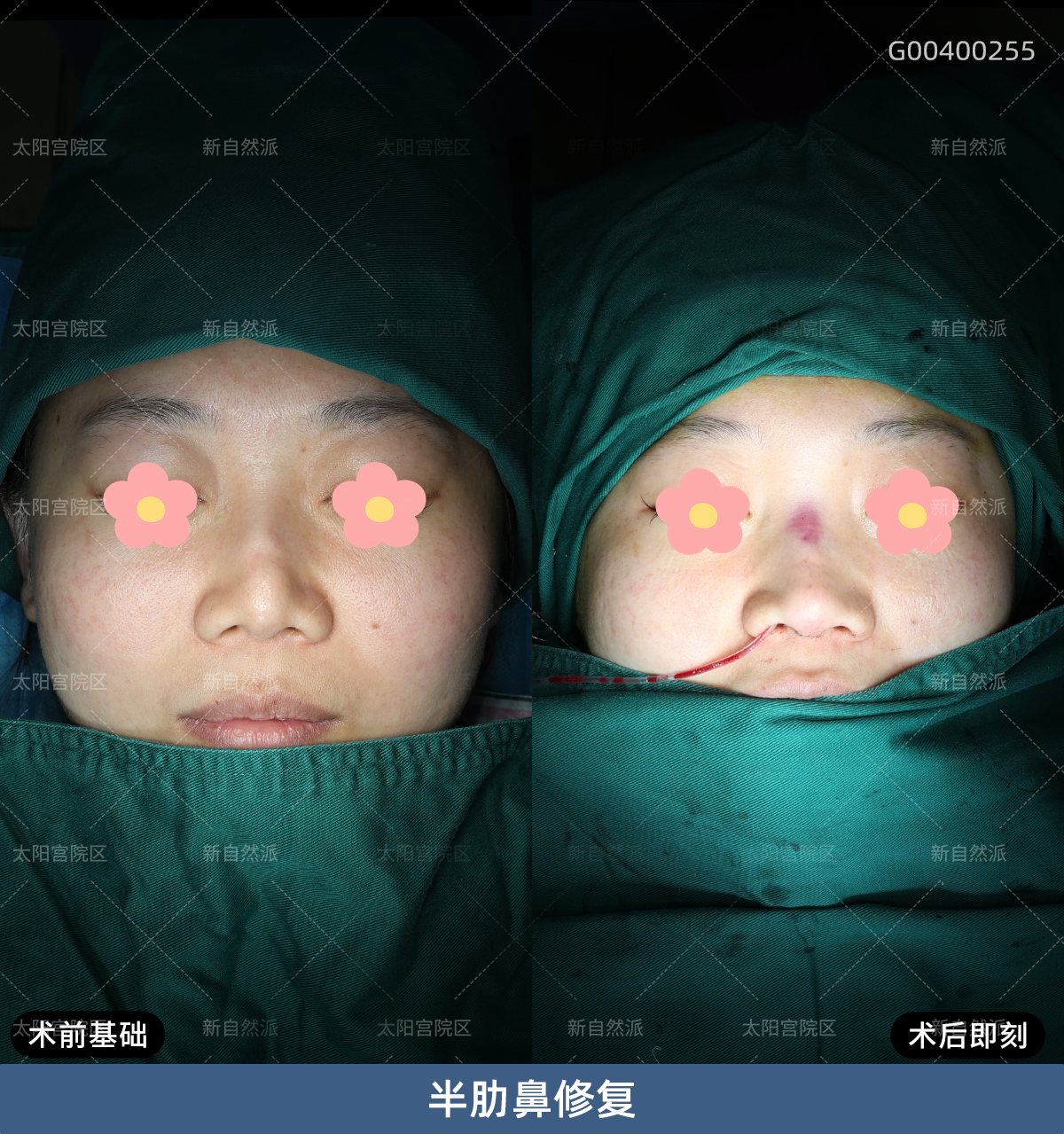 曾做过线雕隆鼻,内部组织被锯齿线破坏的一塌