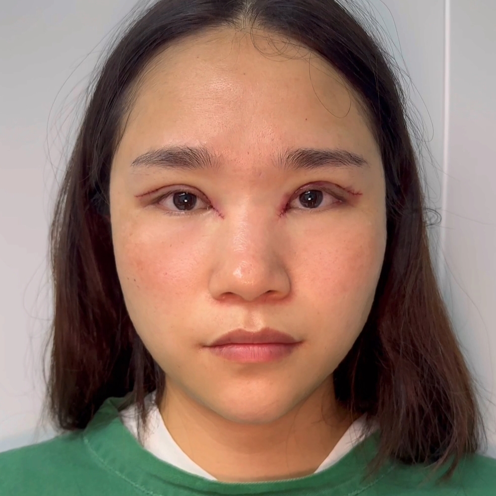 她之前做的双眼皮手术,在内眼角处留下了严重的疤痕,而且原本的平行双