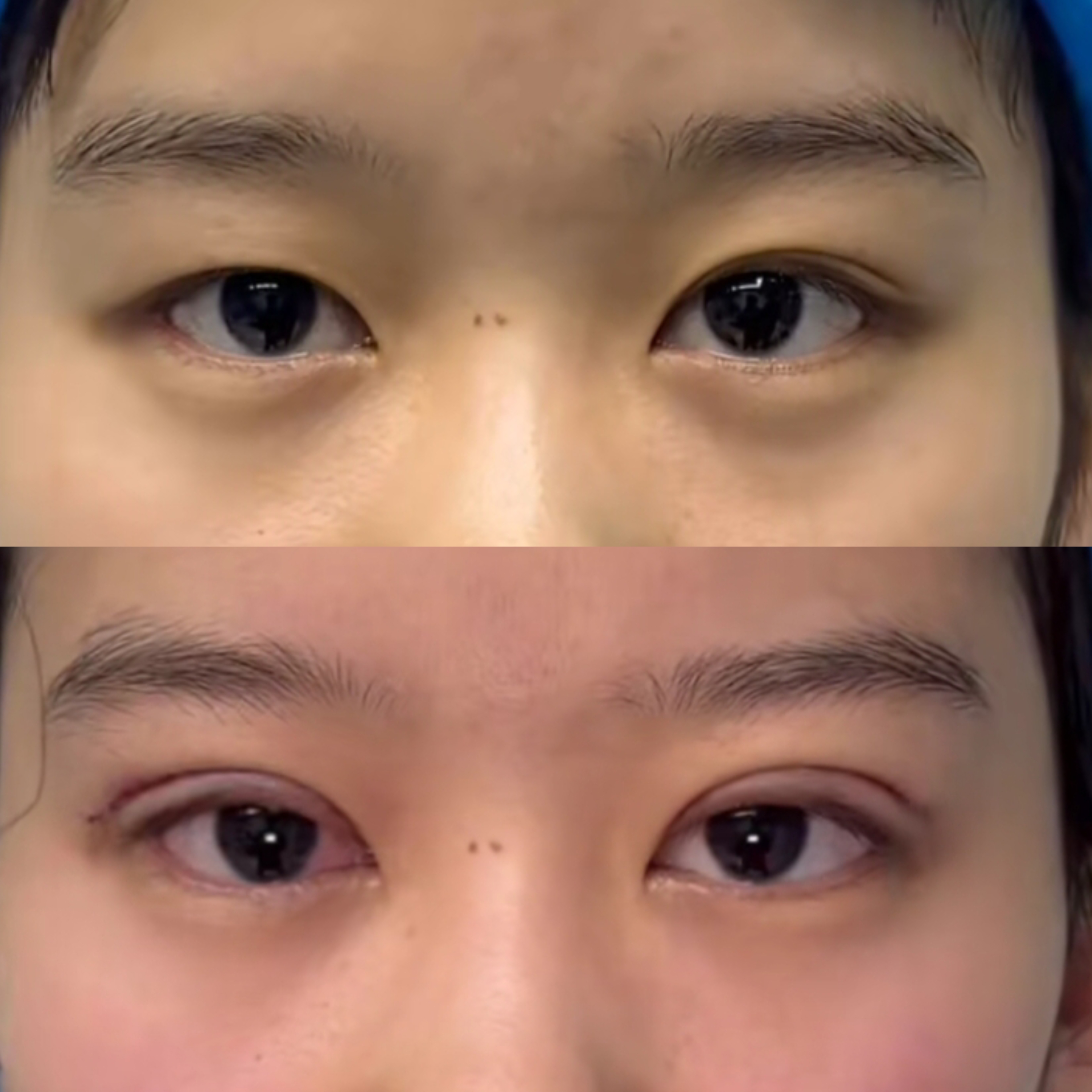 双眼一大一小,不仅影响面部的对称性,还让眼睛看起来毫无神采,总给人