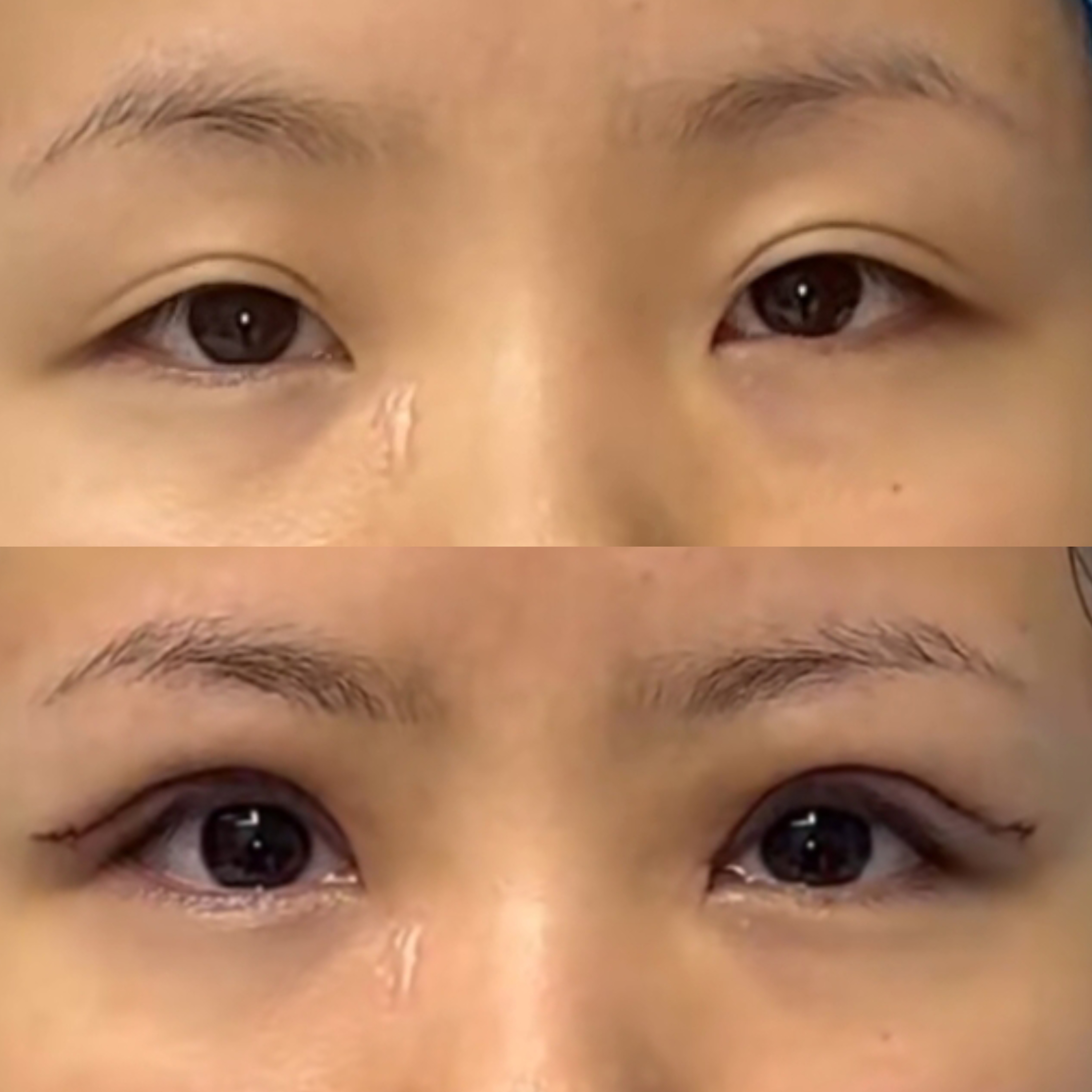 双眼皮变得松弛,提肌无力,使得她每次睁眼都显得费