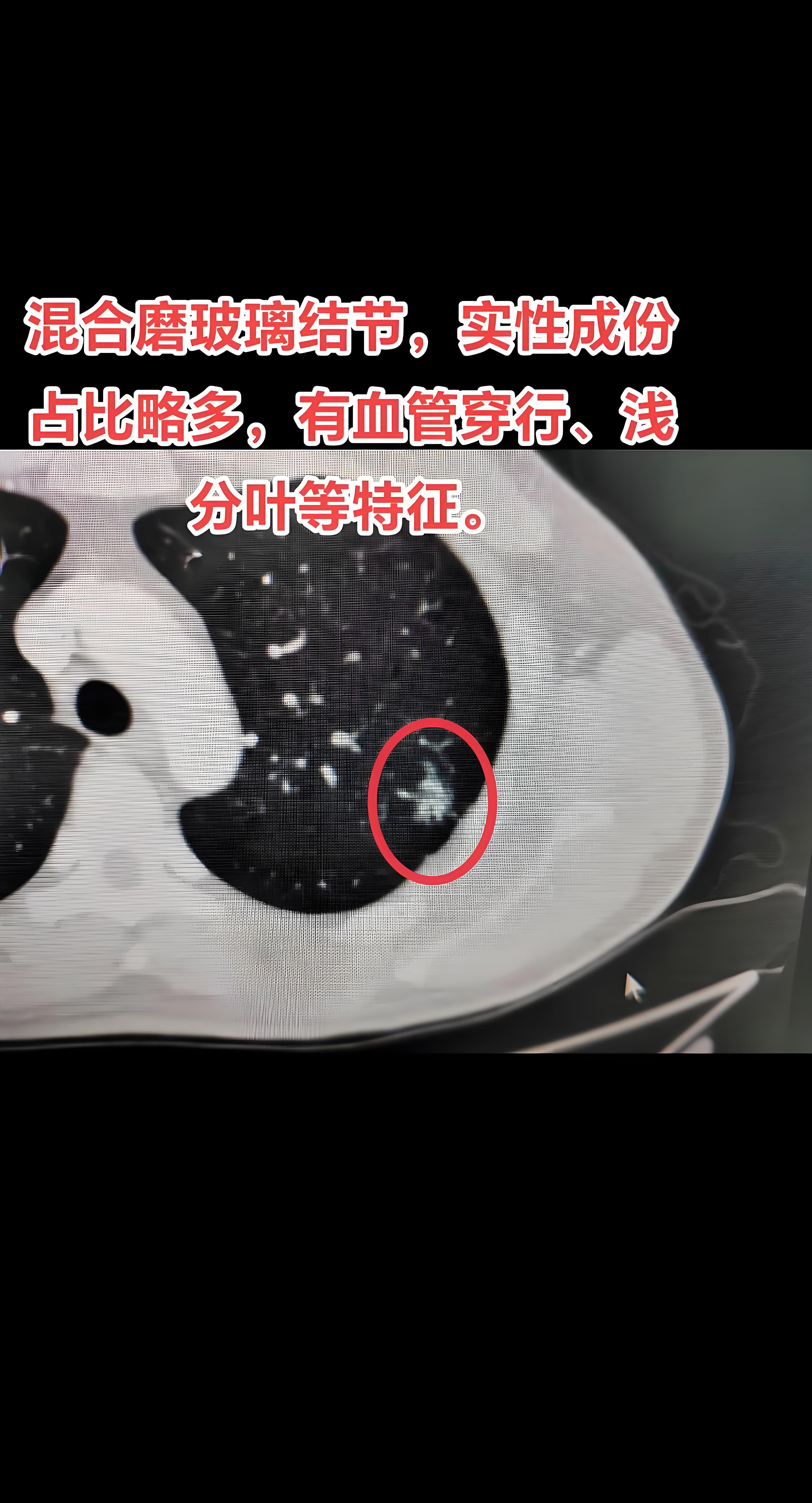 肺结节通常根据影像学表现分为三种类型,即纯磨玻璃结节,混合磨玻璃