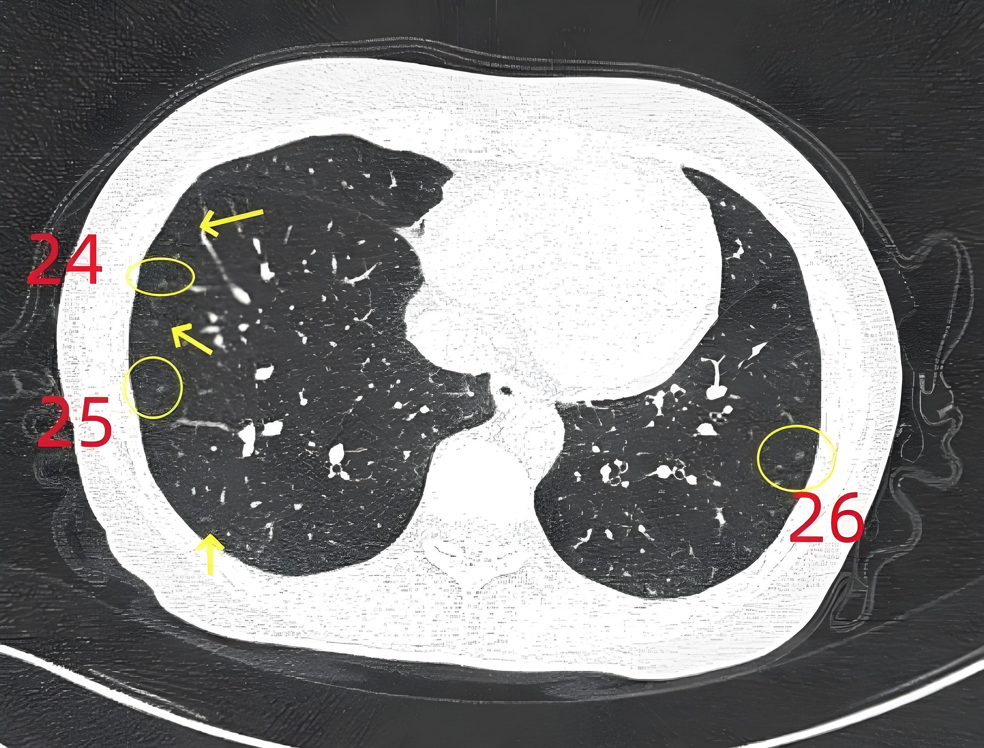 结节ct图片肺结节影像肺结节ct表现肺结节ct影像肺结节影像图肺结节影