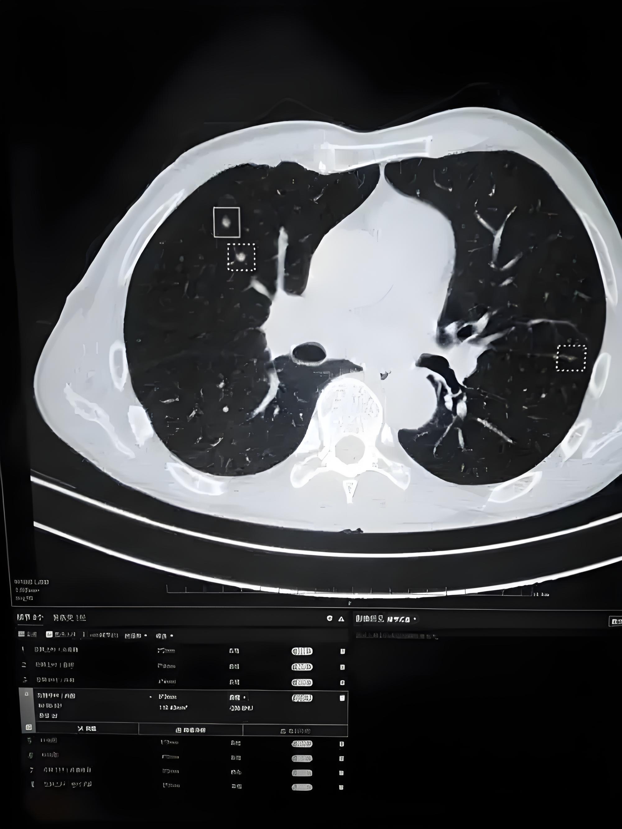 一,全面了解肺结节知识