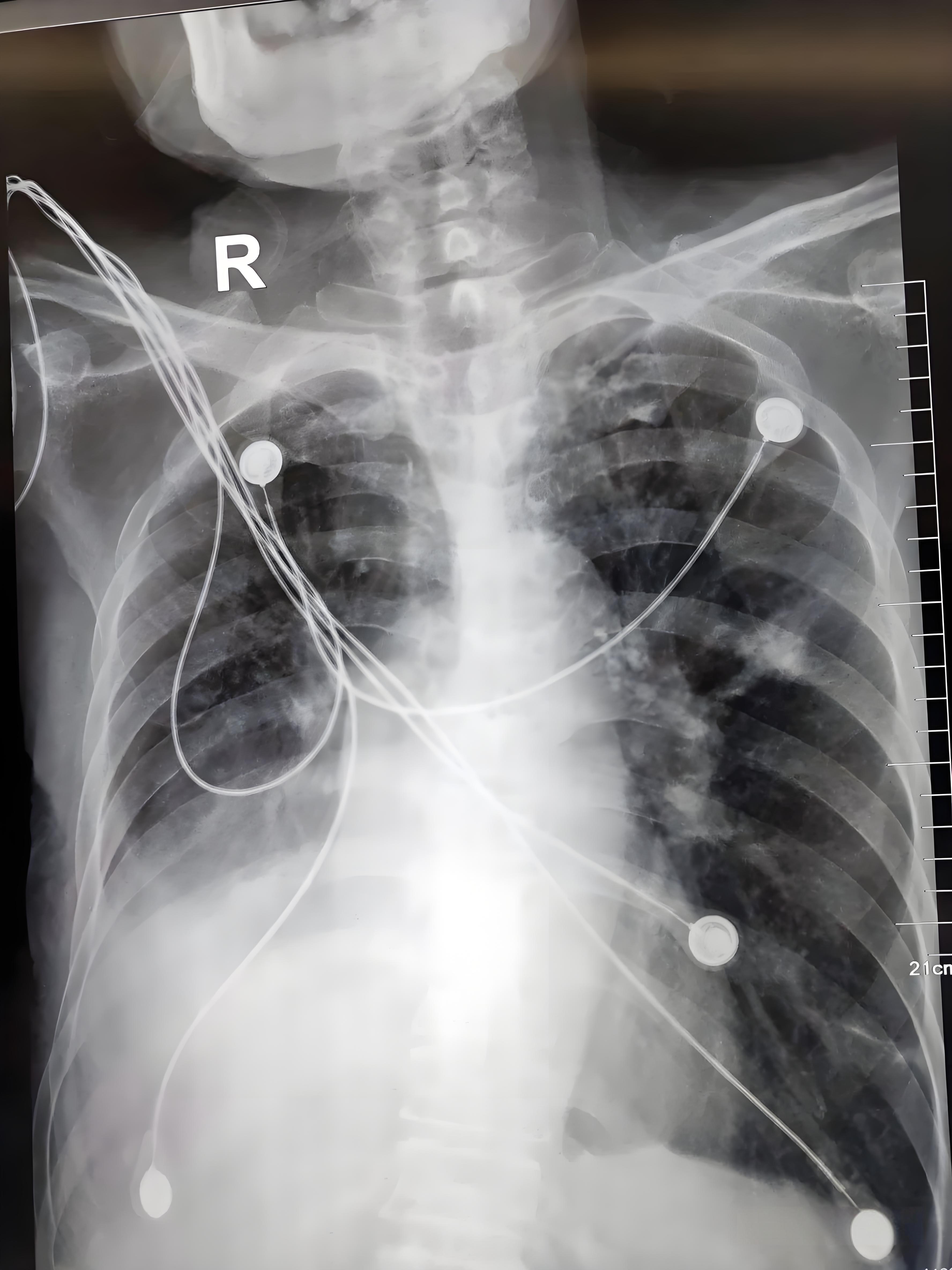 正常情况下,人体胸廓呈椭圆形,前后径小于左右径