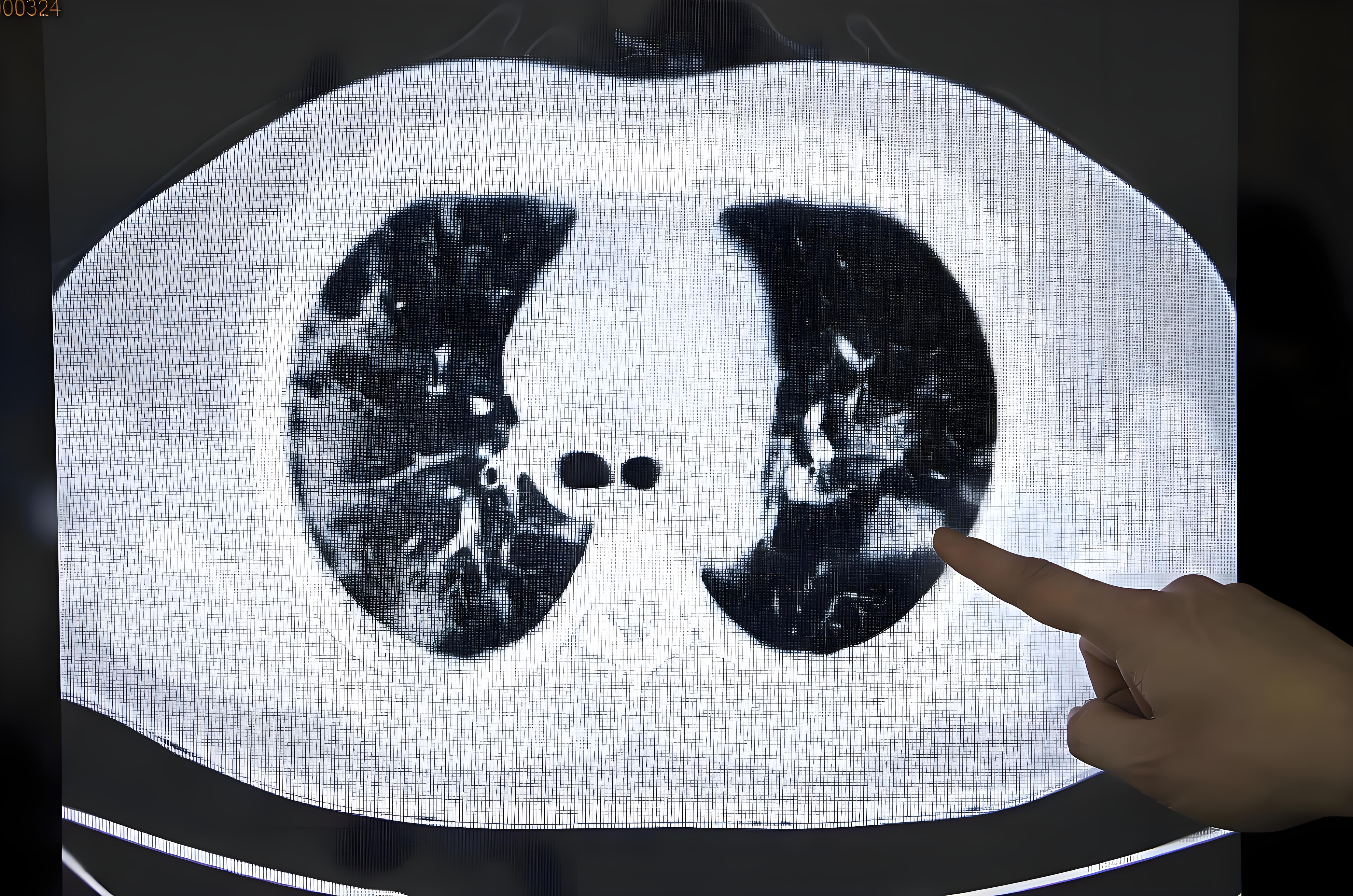 "发现微小肺结节,建议随访"给2个结节病的肺ct片子健康的人肺部ct图片