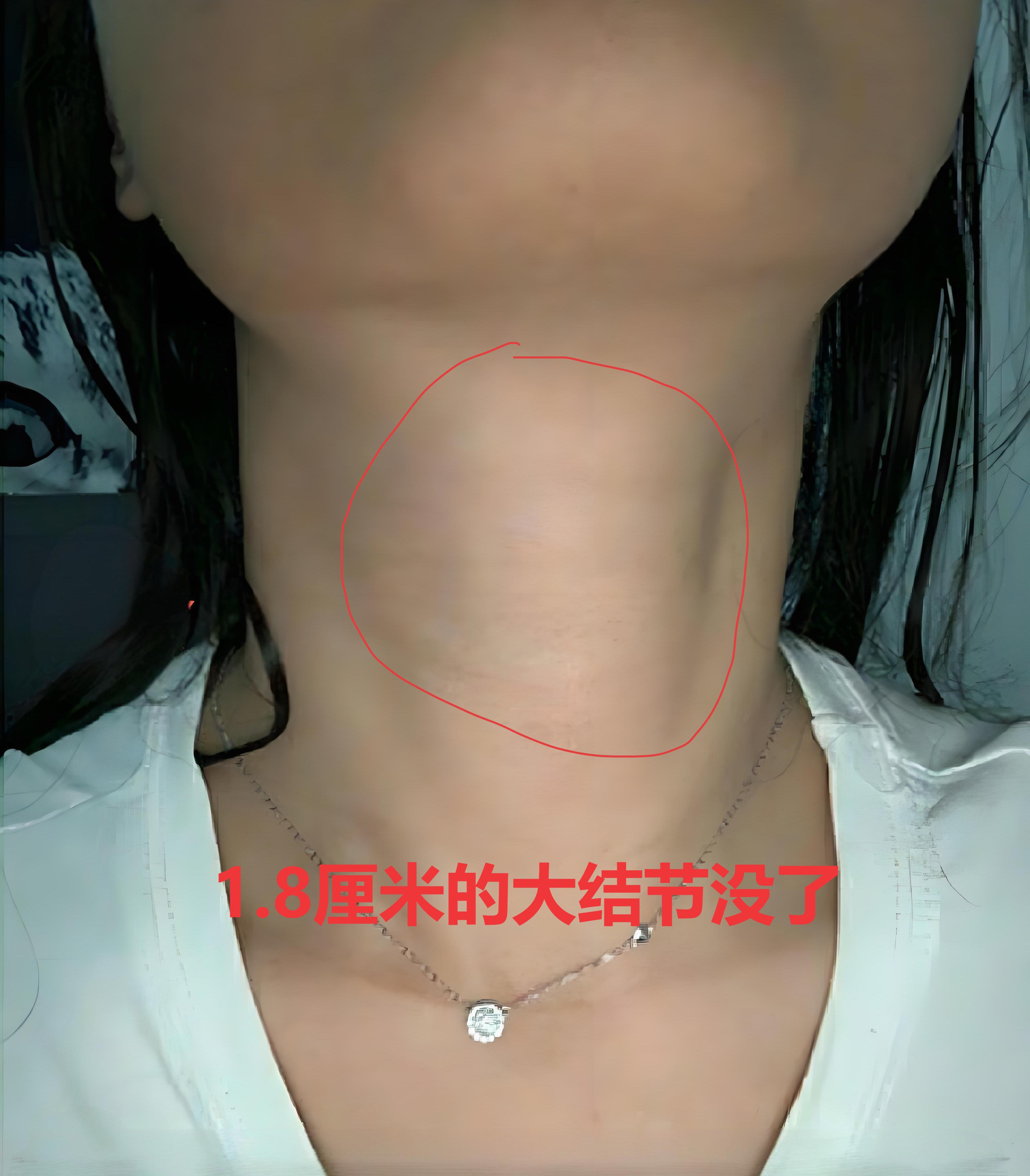 今天想跟大家分享一个真实的病例,希望能给有甲状腺结节的朋友提个醒
