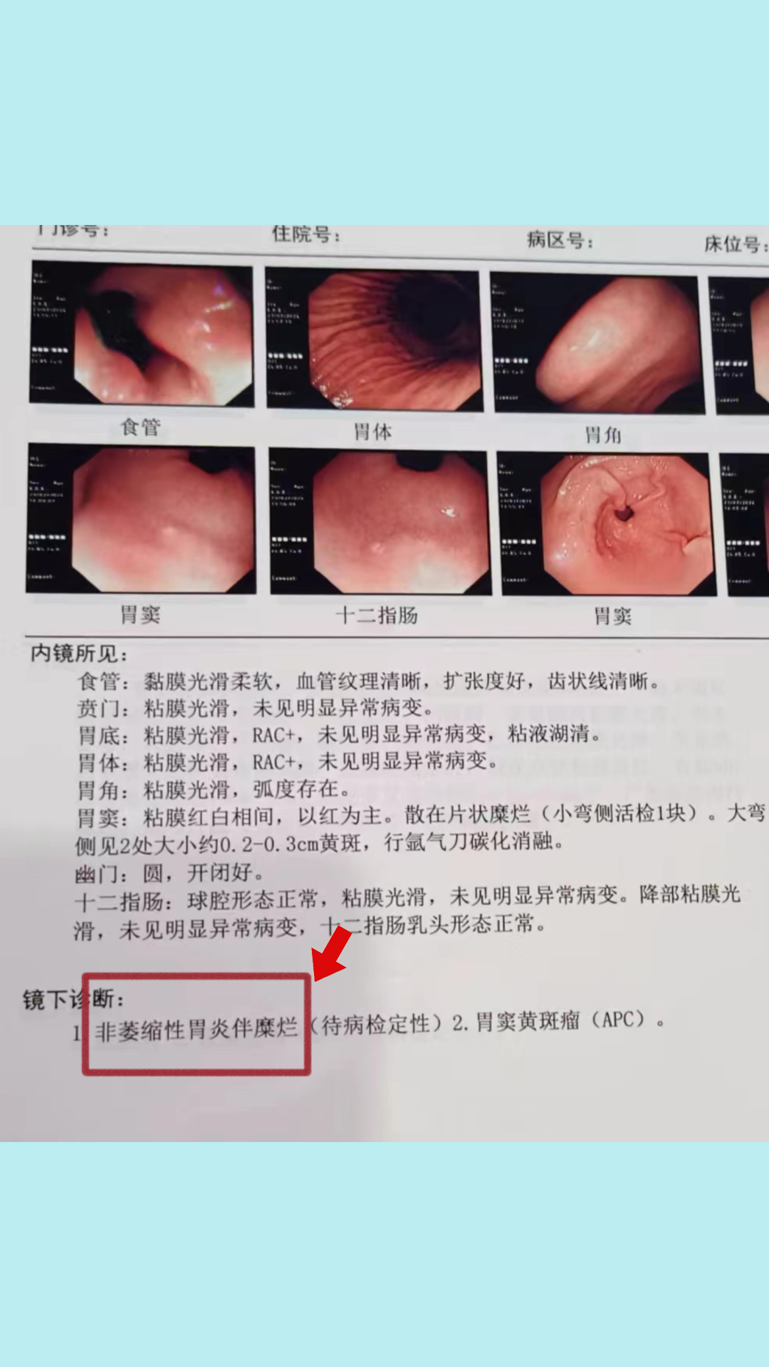 急性肠胃炎诊断图片图片