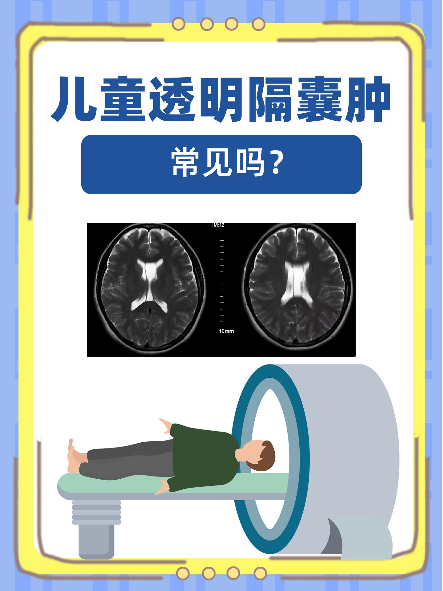 透明隔囊肿,实际上是一种在脑部特定区域