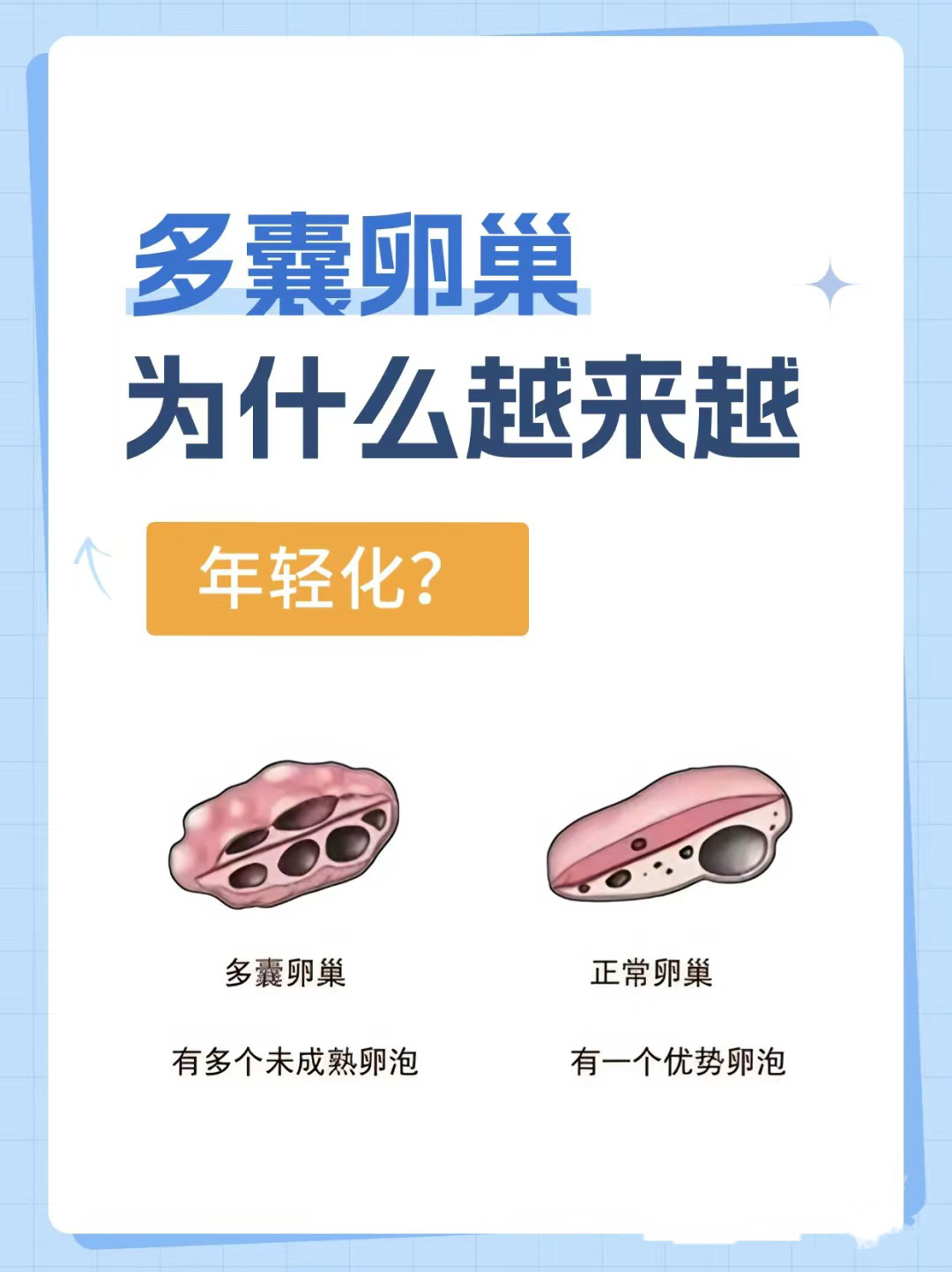 多囊性卵巢综合症治_多囊卵巢综合症彻底治愈