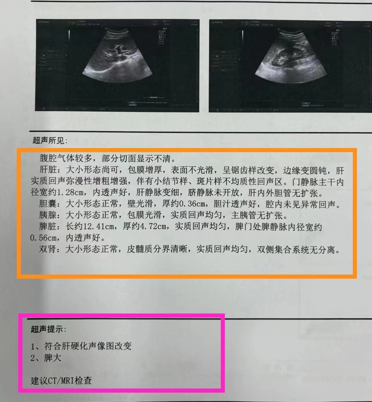 肝脏彩超你会看吗? 1,看有没有脾大. 2,看有没有强回声区