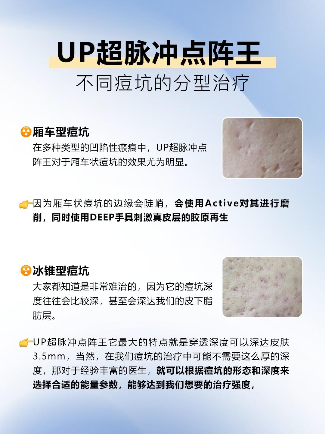 箱车型痘坑 虽然开口没有碾压型大但是比这种类型的痘坑深 	 冰锥