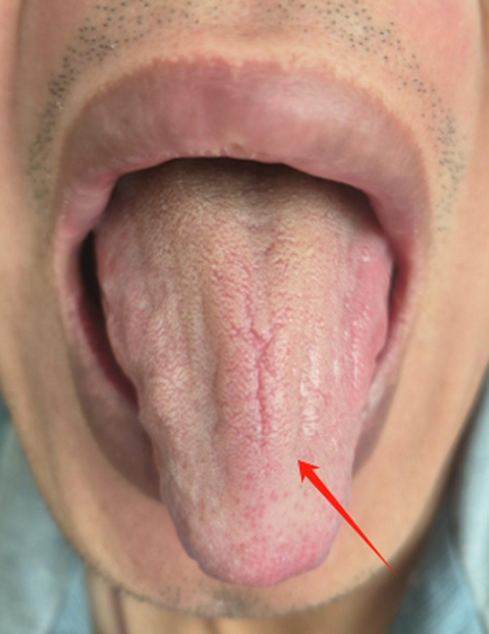 这是一个上焦气滞瘀滞和肝郁的舌头  这个舌质颜色偏暗,呈紫红色,舌尖