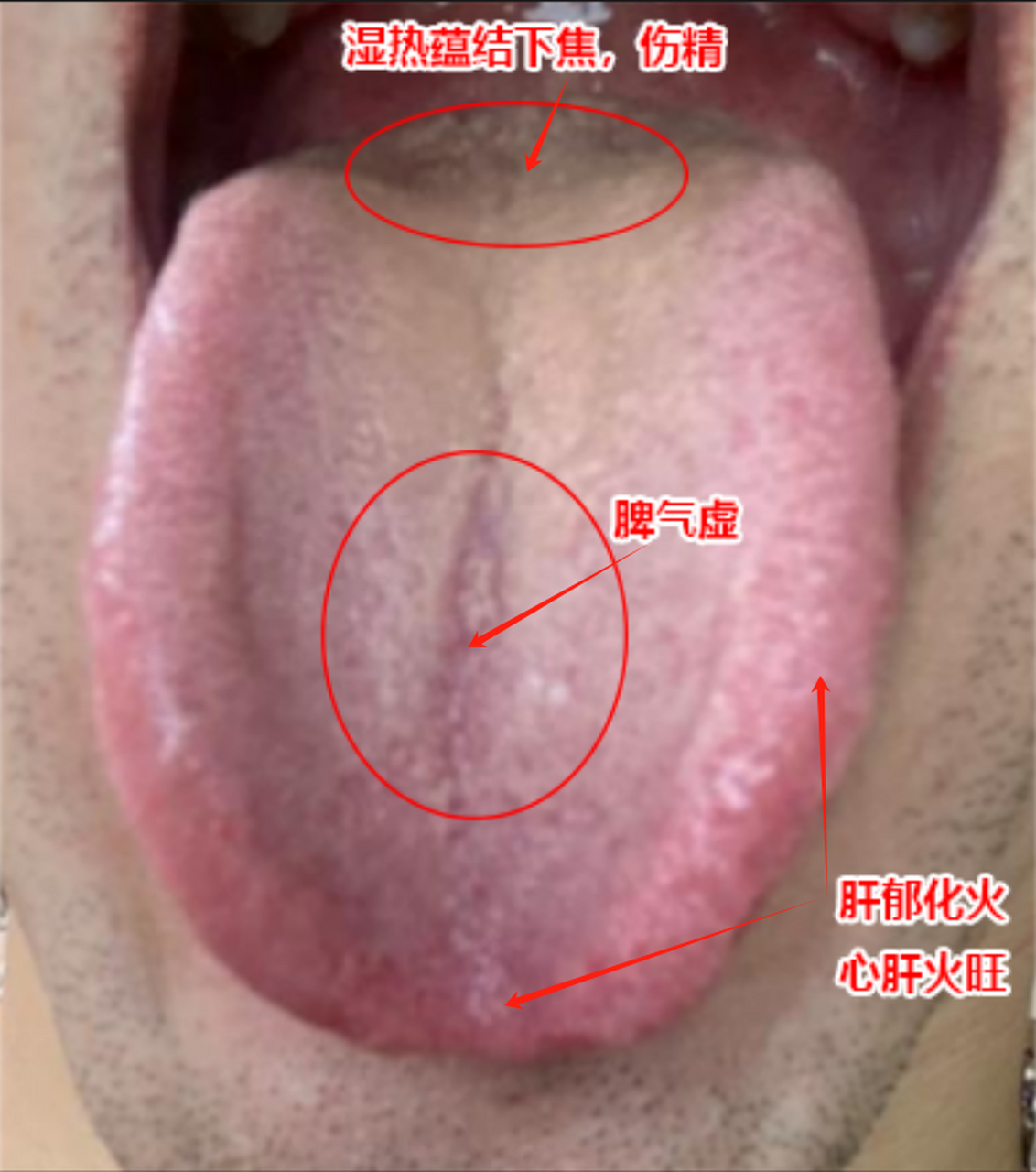 舌苔黄腻,汇集在下焦,湿热重成这样,还以为没什么事,都湿热扰肾了!