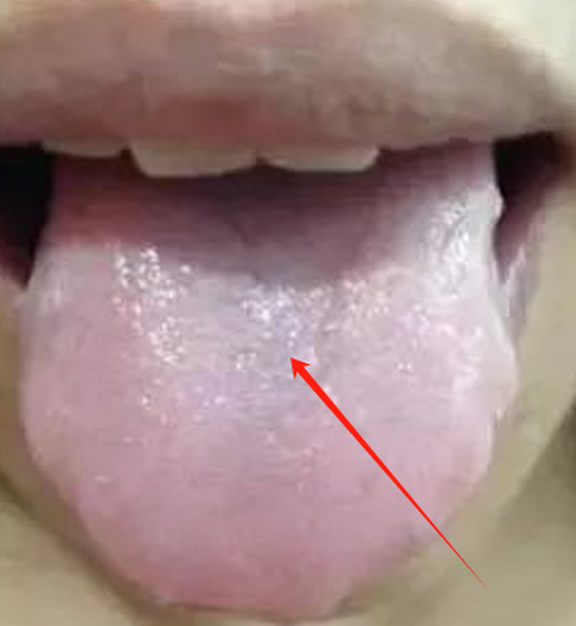 这是一个典型的齿痕舌 整个舌苔呢颜色是比较淡的白滑苔 舌两边的齿痕