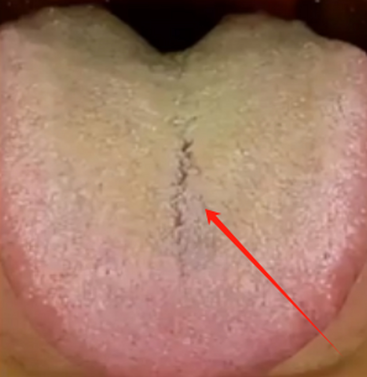 这是一个黄厚腻苔舌头 这个舌头的苔呢又黄又厚,而且呢是比较腻的 舌