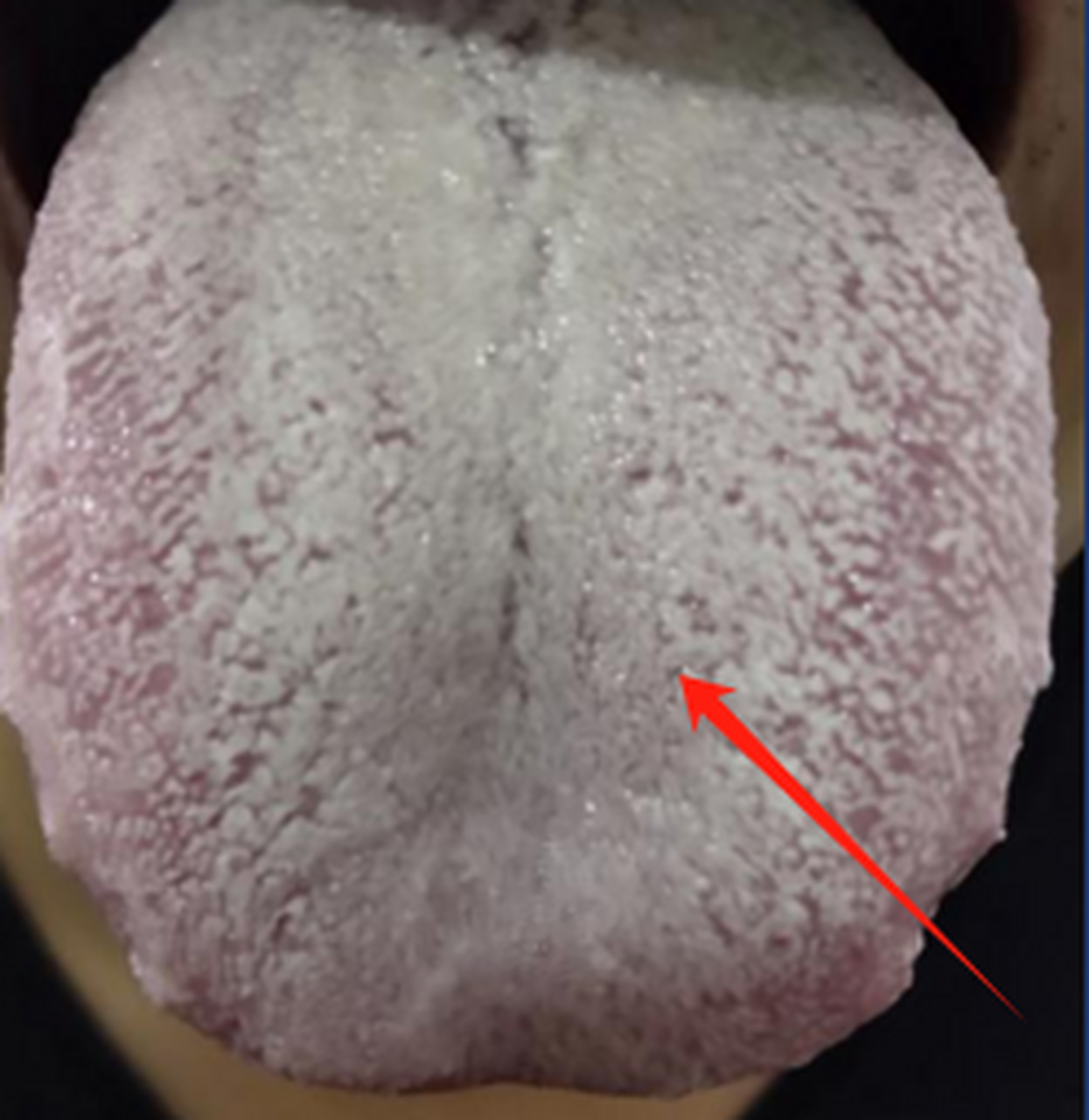 这个舌苔白而且厚腻,这一般意味着体内有寒湿之邪 在中医理论中,寒湿