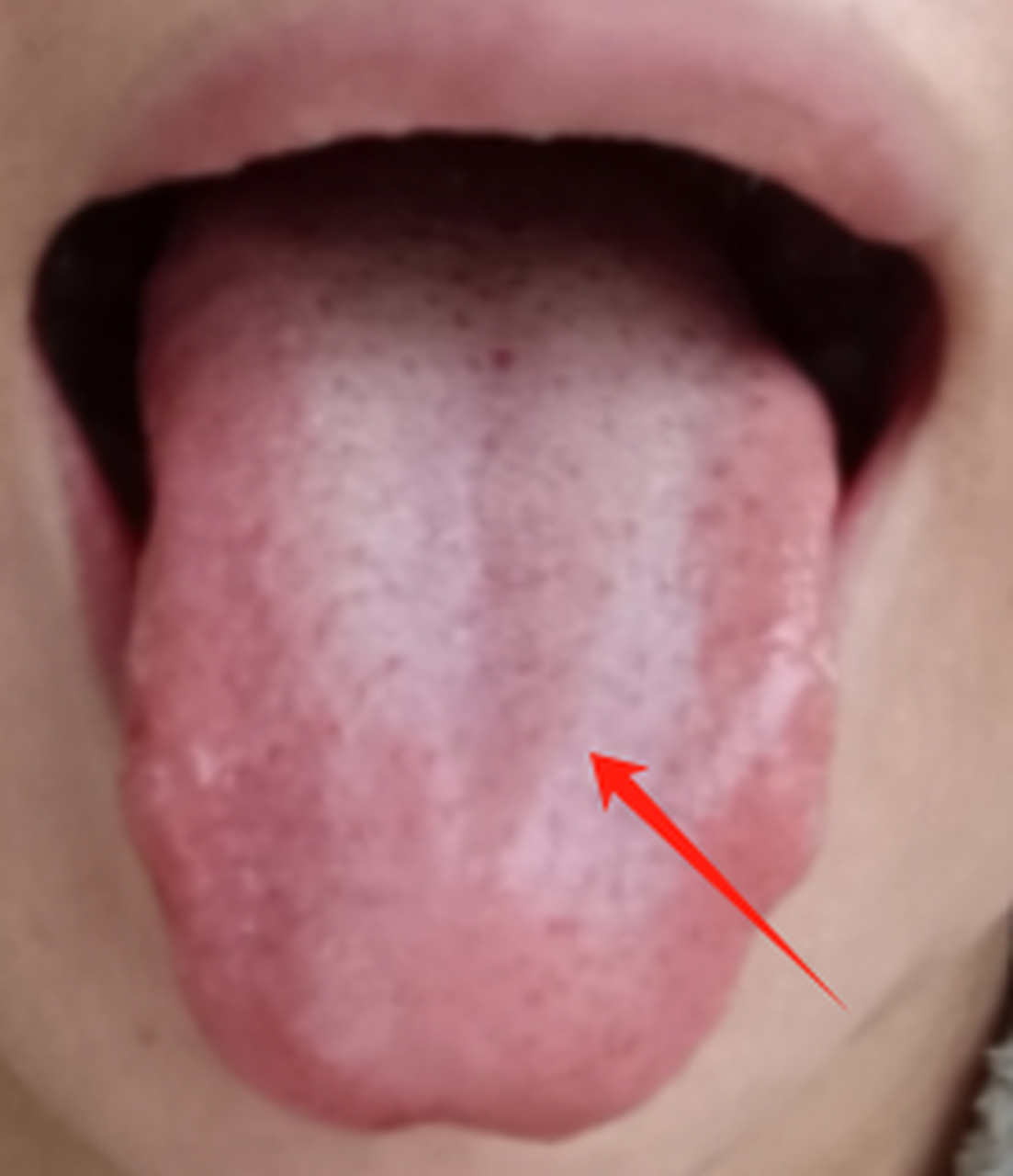 这是一个脾虚湿气重,肝郁,肾阳虚的舌头  整个舌头,舌苔呈现薄白,舌边