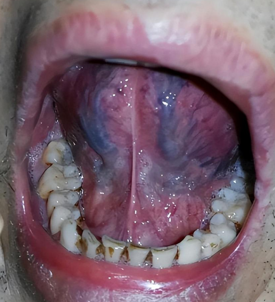 特别是舌苔白厚腻,舌下青筋发粗发黑的人,这时候有些人,就会使