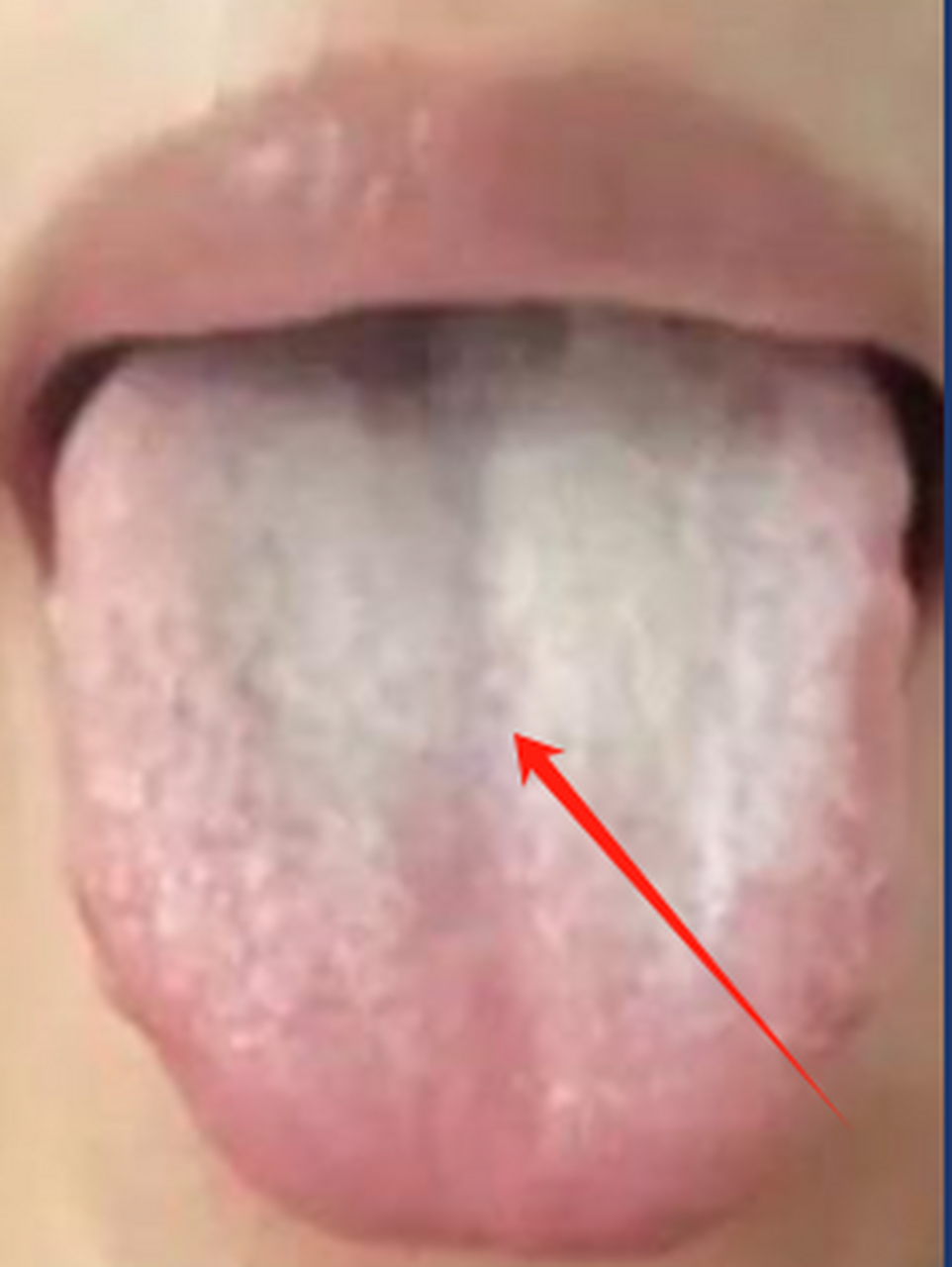 尤其是舌尖和舌两边特别明显 这表明她的心火很旺 心火旺盛常常导致