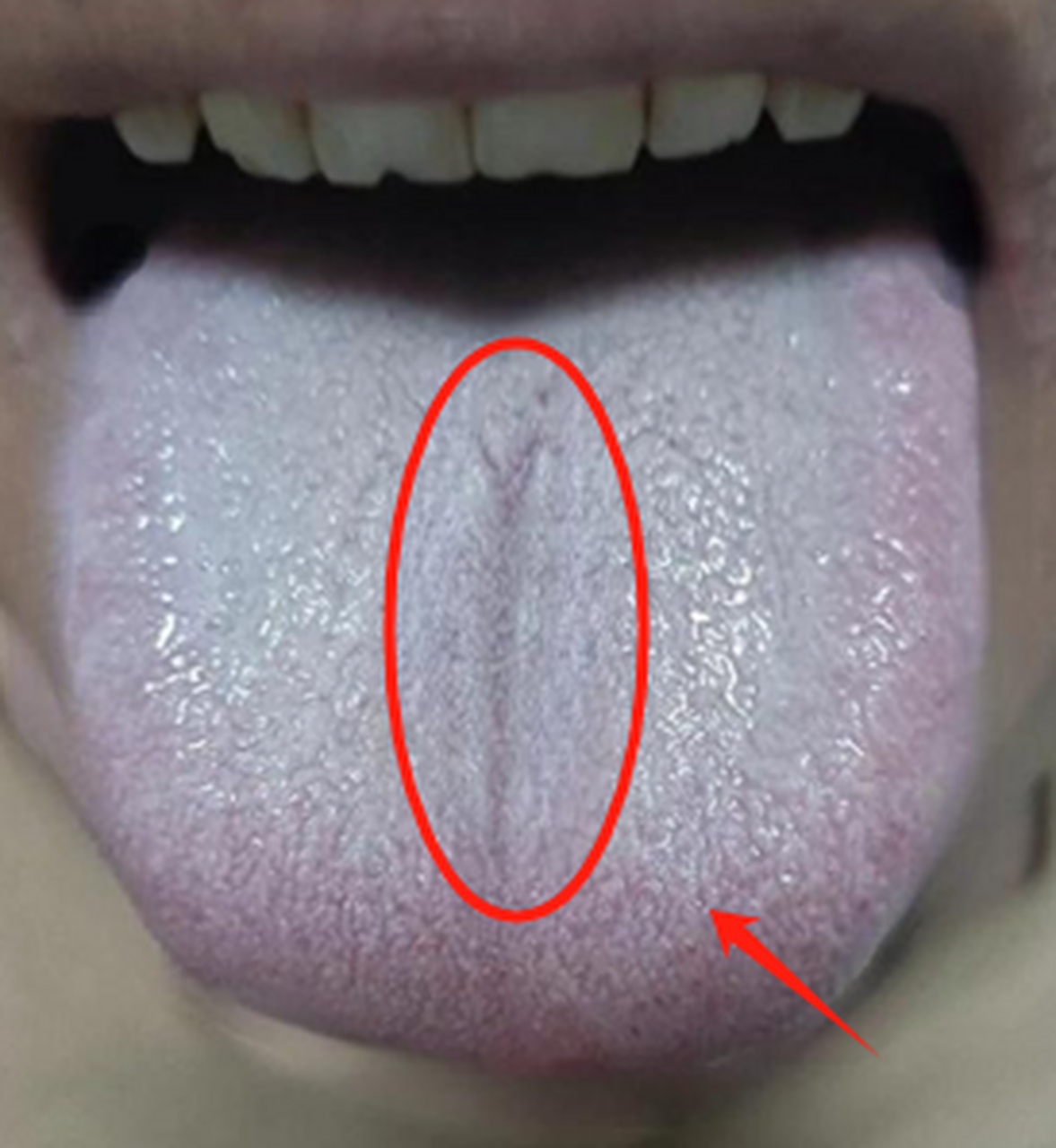 整个舌苔白腻,几乎覆盖了整个舌面,说明肾阳虚,温化不掉痰湿 舌质淡白