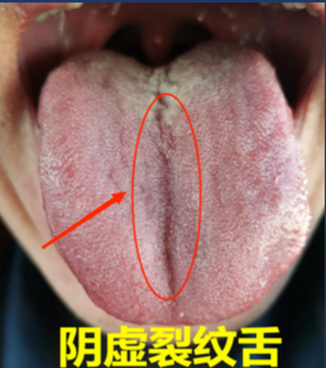 这是一个阴虚裂纹舌 我们可以看到舌质很红,舌头上有裂纹,舌面苔少 这