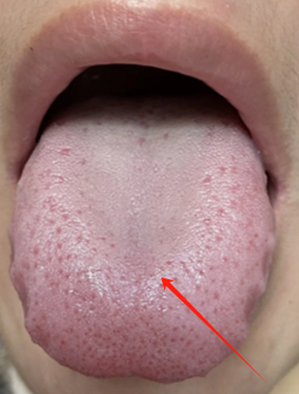 舌头两侧凸起,有很多气滞点 这说明他的肝区可能有一些瘀滞的问题