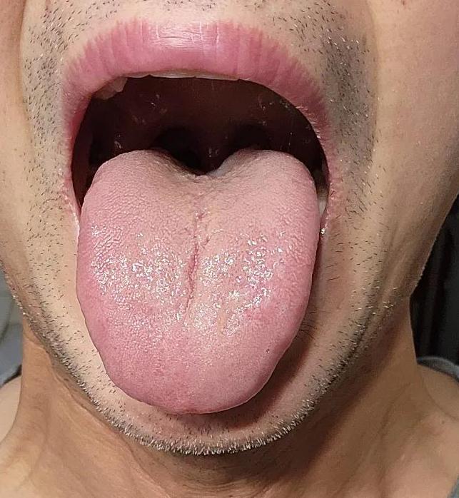 渐冻人舌头萎缩图舌头萎缩图片舌头不健康的图片枯舌小舌头下垂图片