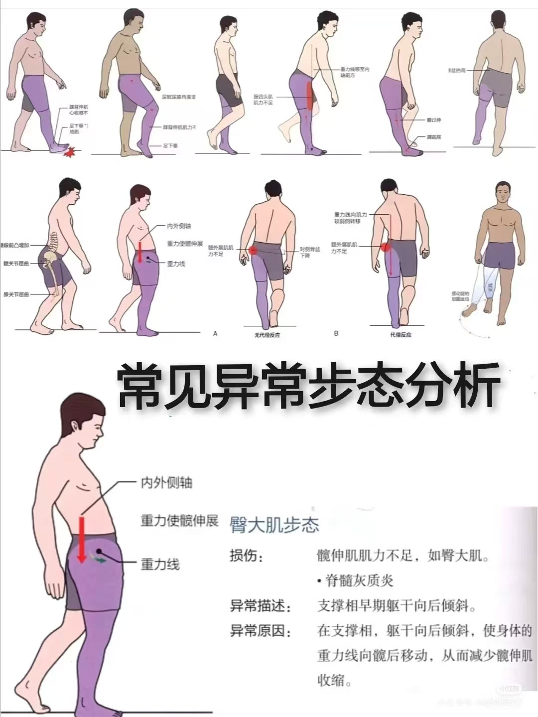 通过步态分析来评估患者是否行走功能异常,在制定训练