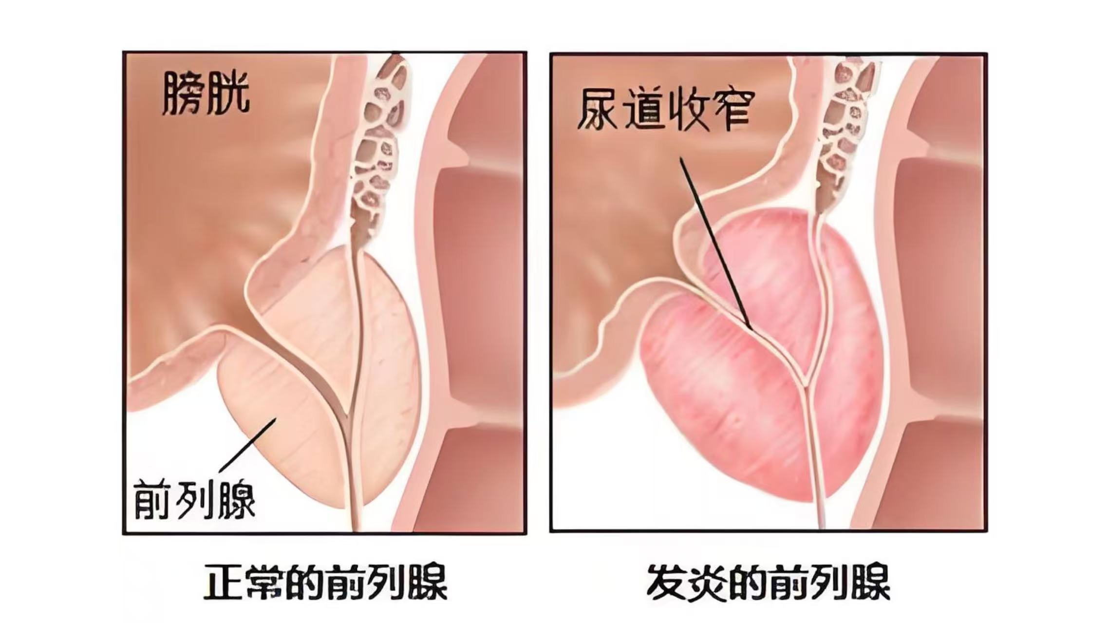 柳州前列腺炎